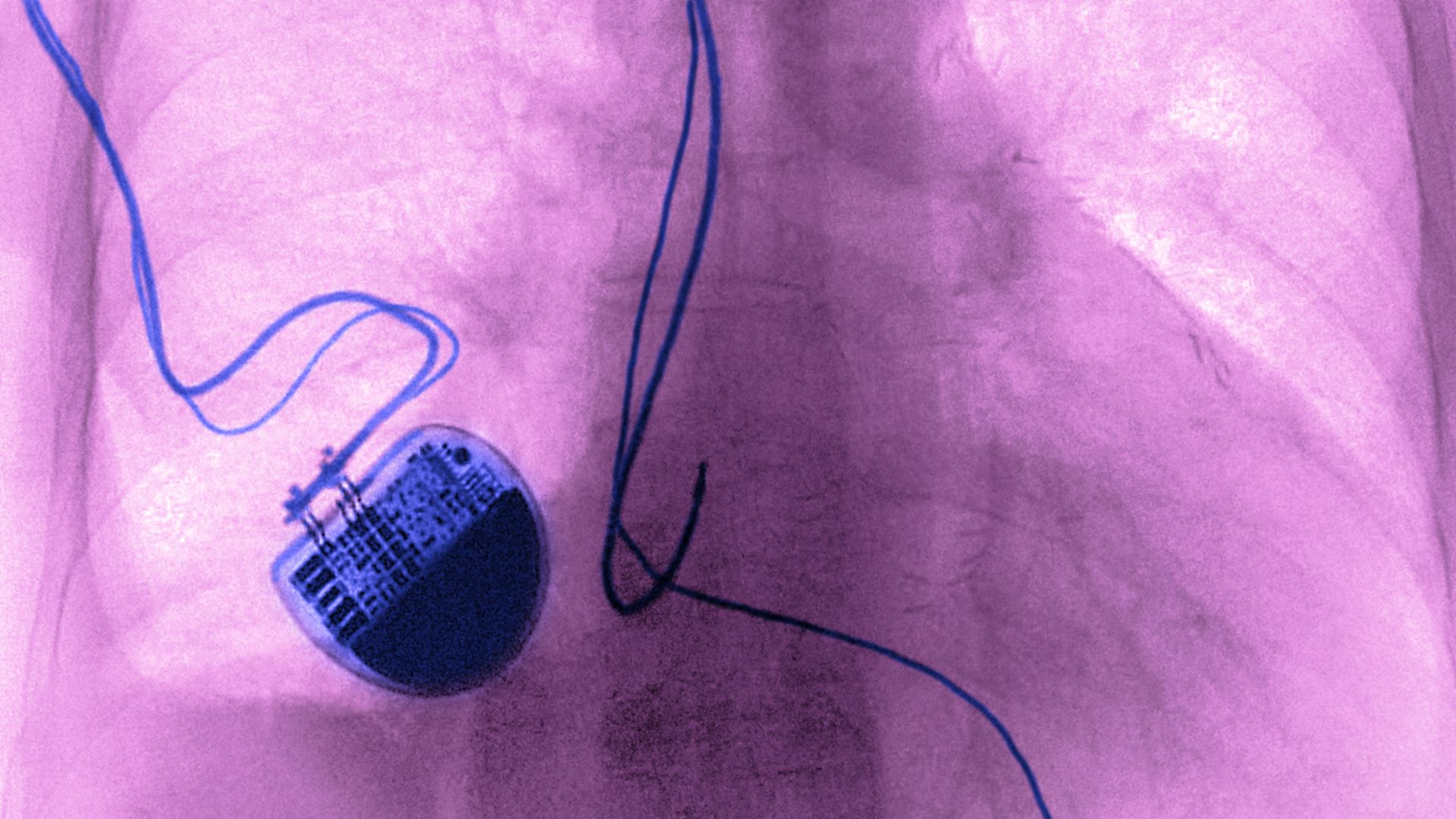 Implanted Pacemaker seen on a frontal chest x-ray.