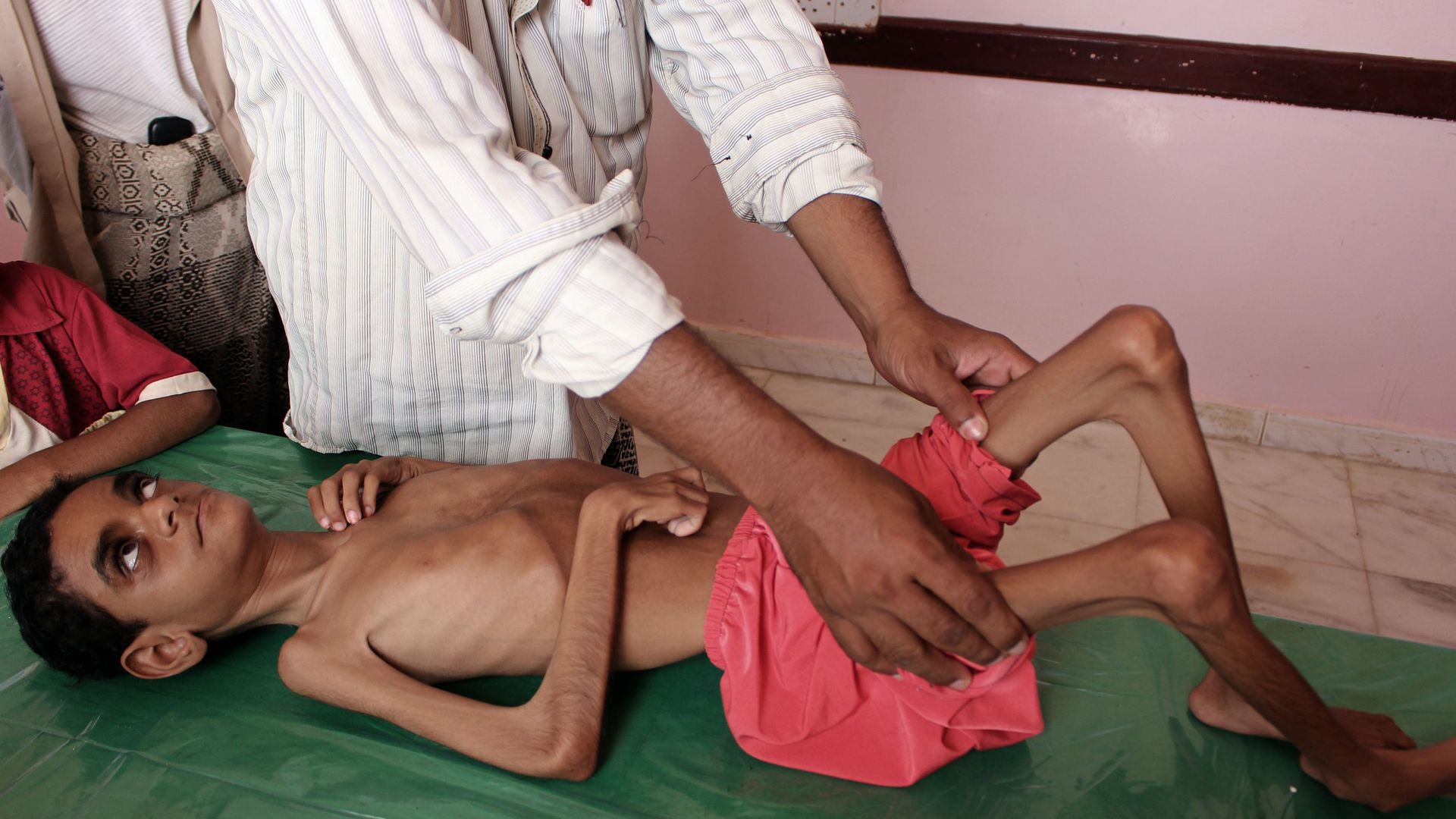 Yemeni child suffering from malnutrition