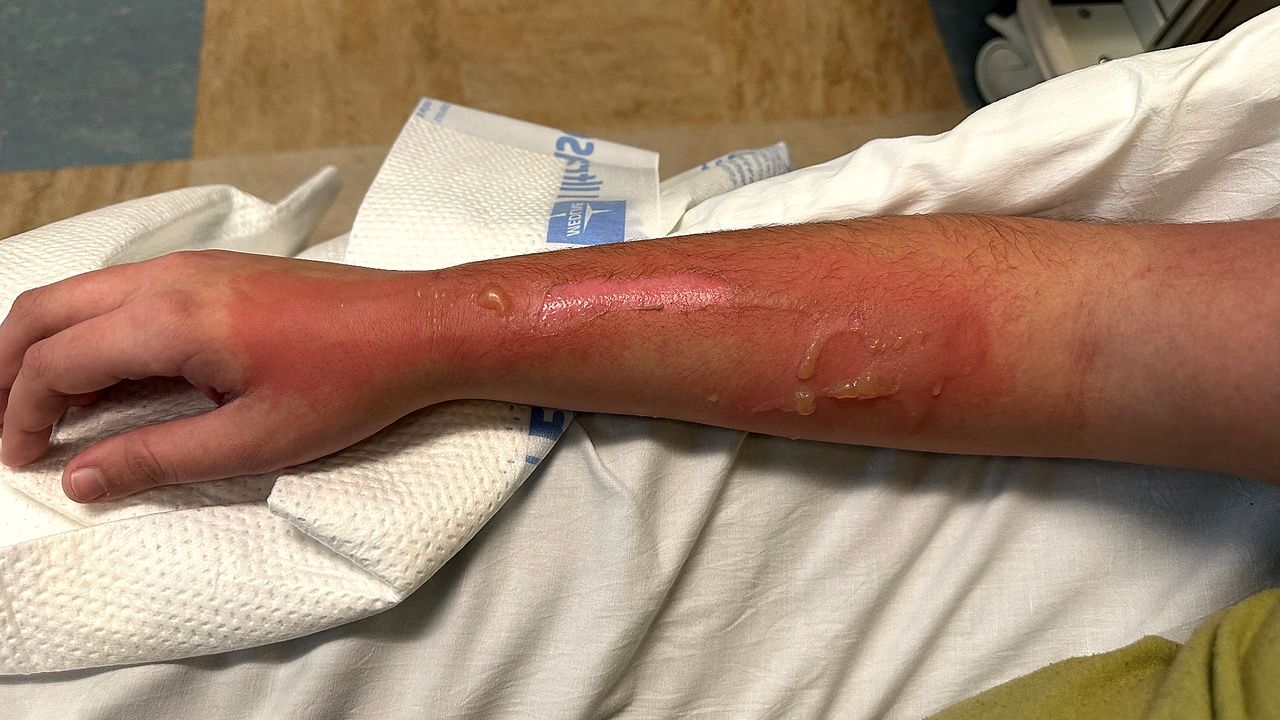 A photo of a burn.