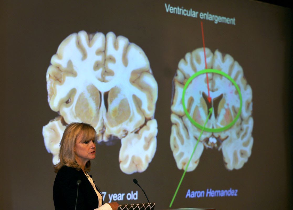 Ann McKee announces her findings on her examination of Aaron Hernandez's brain in 2017.