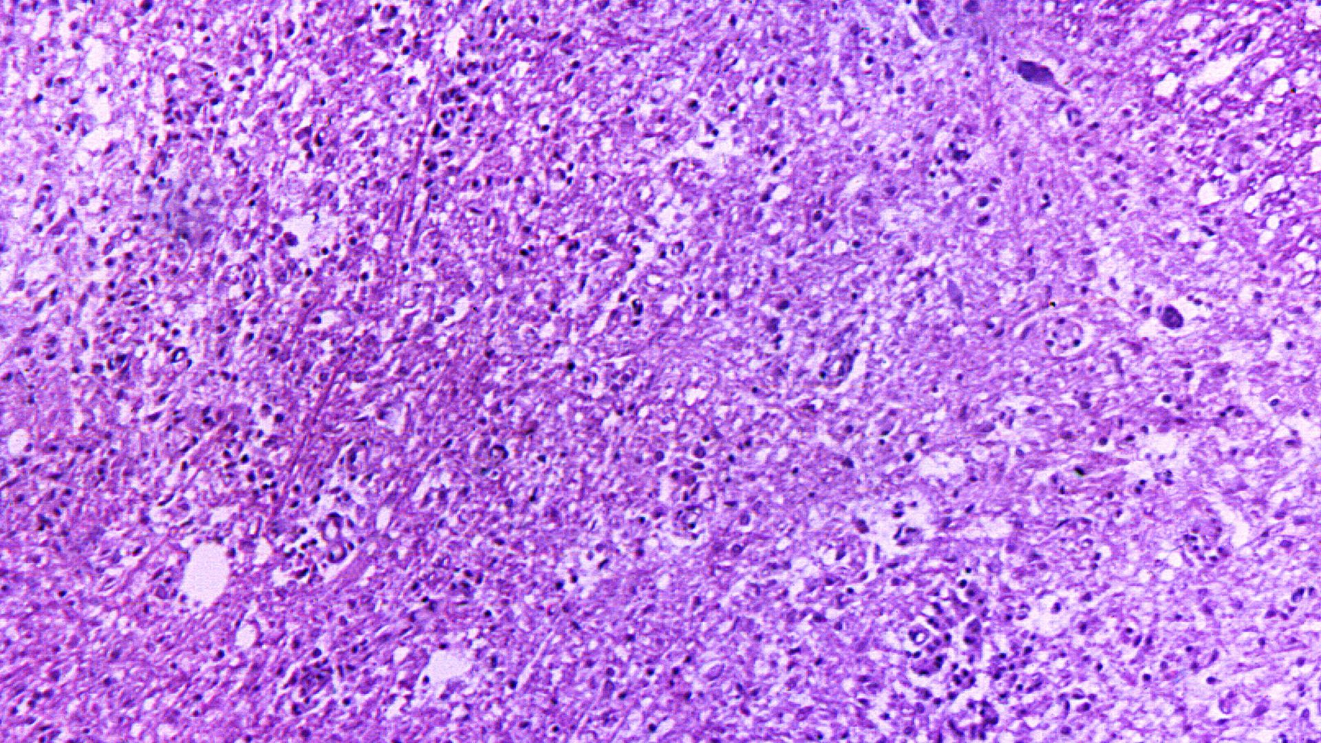 A photomicrograph of the cervical spinal cord affected by polio type-III virus captured in 1990.
