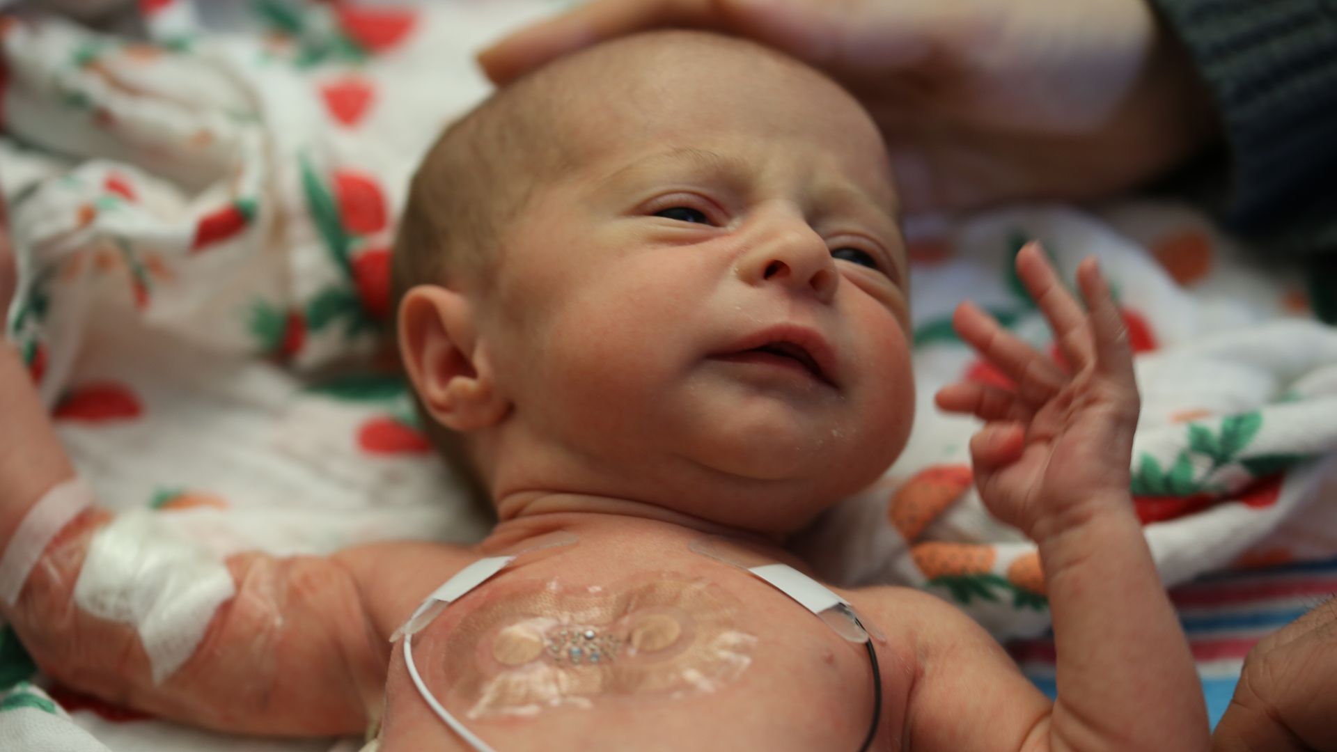 Photo of a newborn baby in NICU with sensors and wires attached to the baby