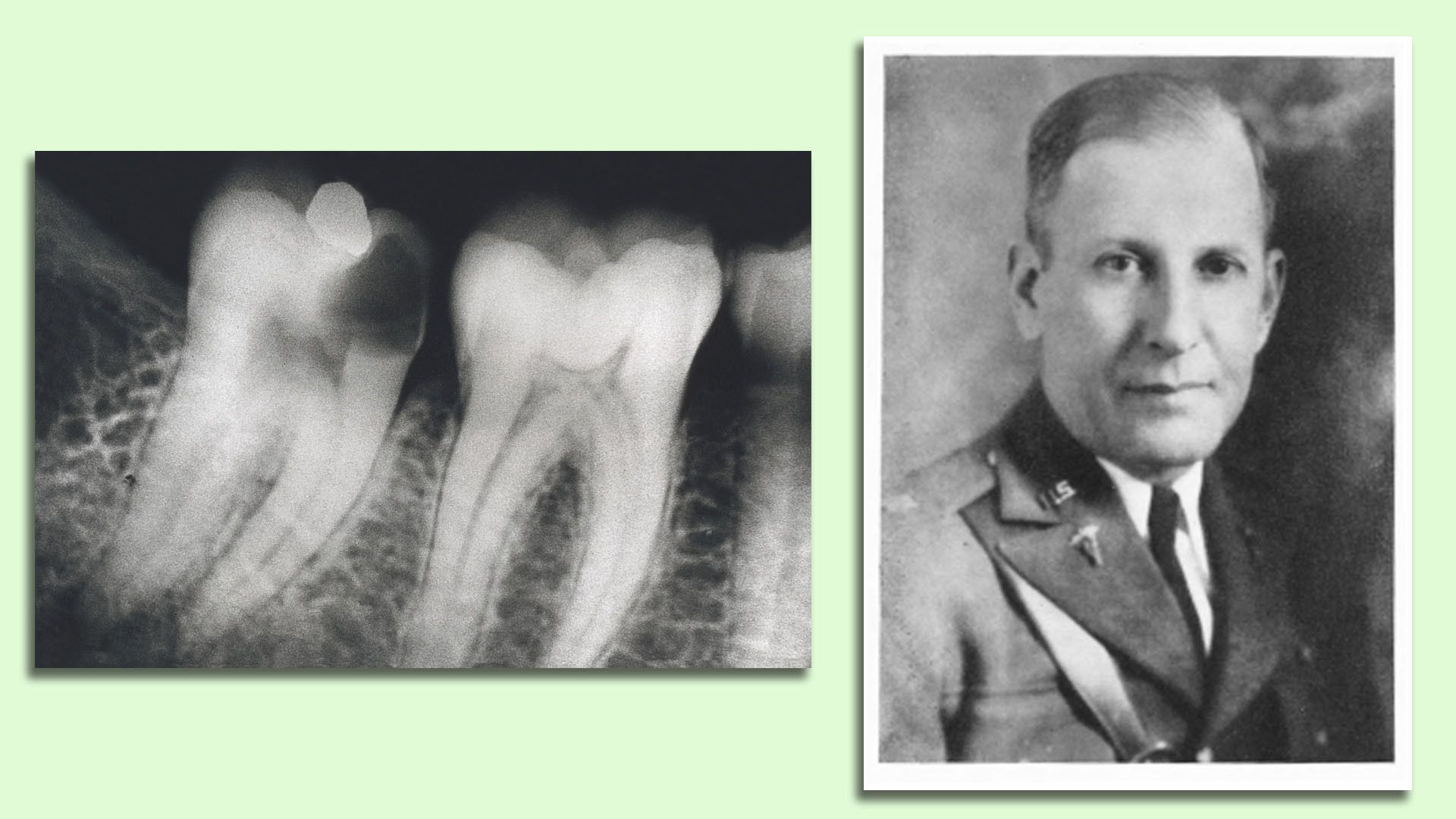 X-ray of two teeth, one with a dental cavity.