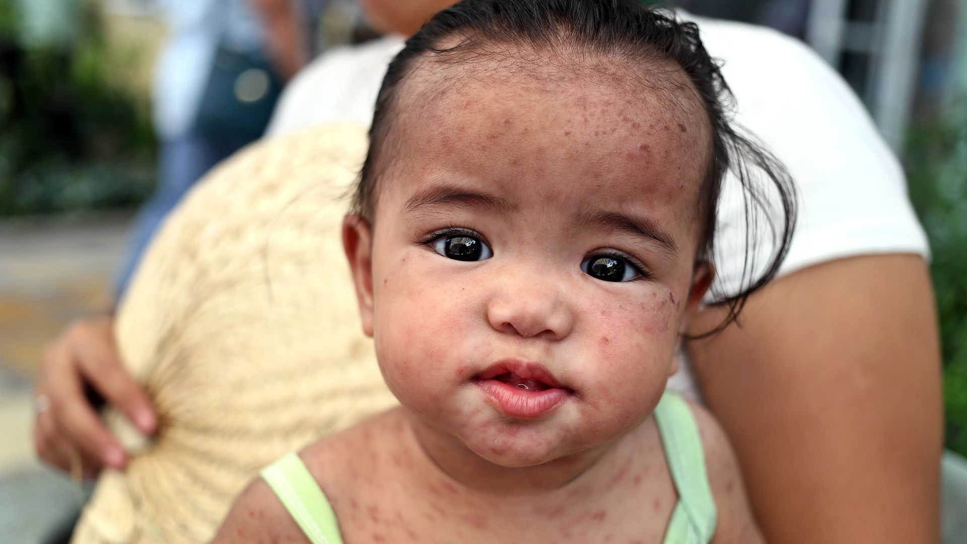 Toddler with measles in the Philippines