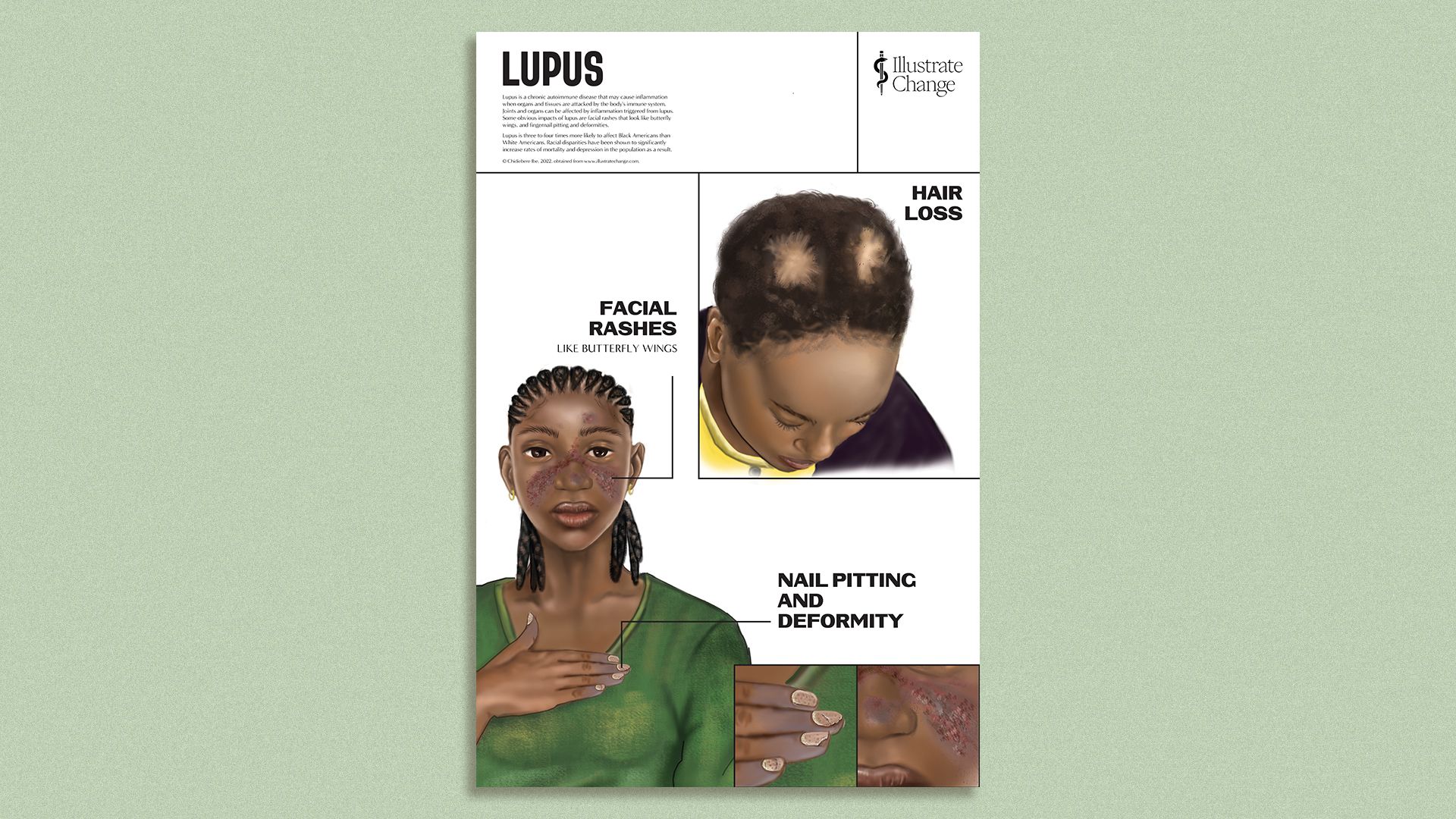 A medical illustration of a Black young girl with Lupus. She has a rash on her face and two bald spots on her head. She is wearing a green shirt and has her hand on her chest. 