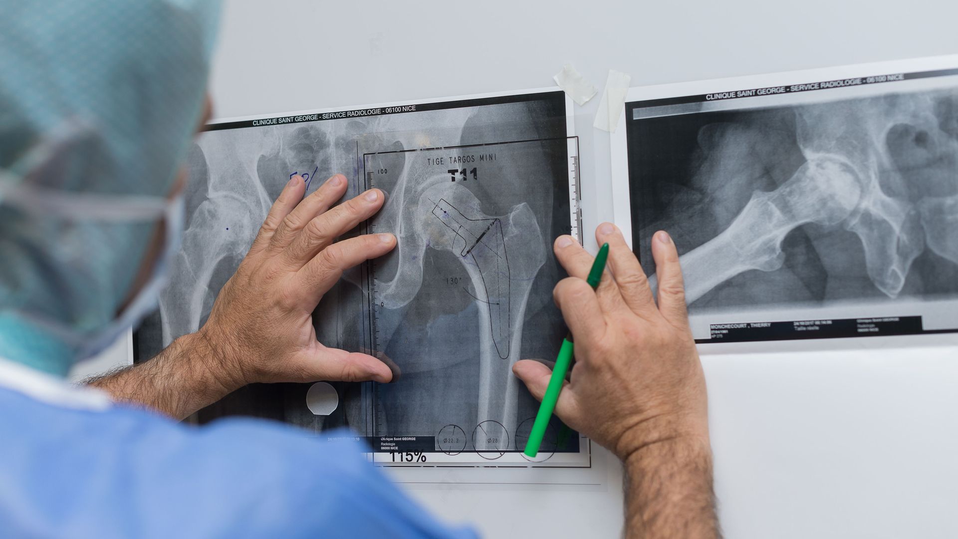 Orthopedic surgery, Saint George Clinic, Nice, France Fitting dual mobility hip prosthesis in patient suffering from osteonecrosis The surgeon plans the operation 