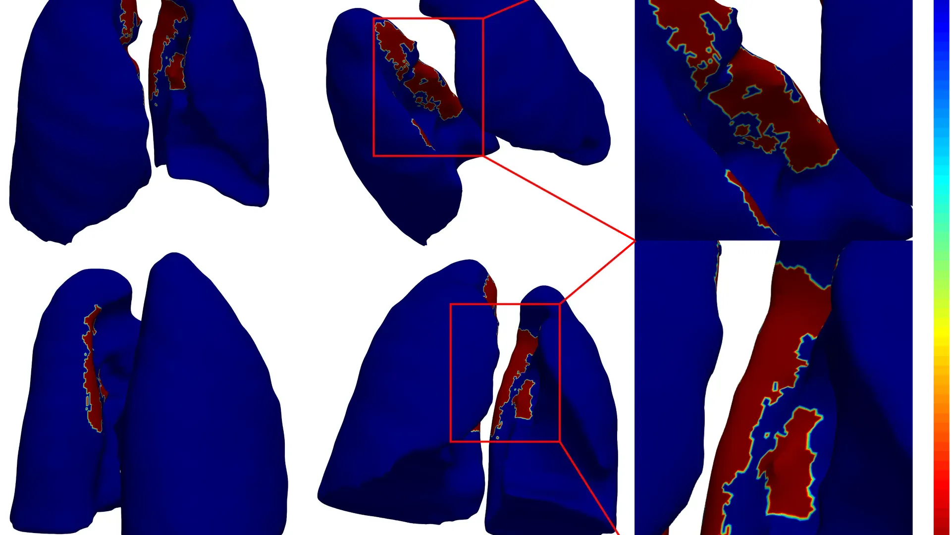 3D model of lungs with COVID-19 damage. Blue areas show mild COVID-19. Red areas highlight severe COVID-19. 