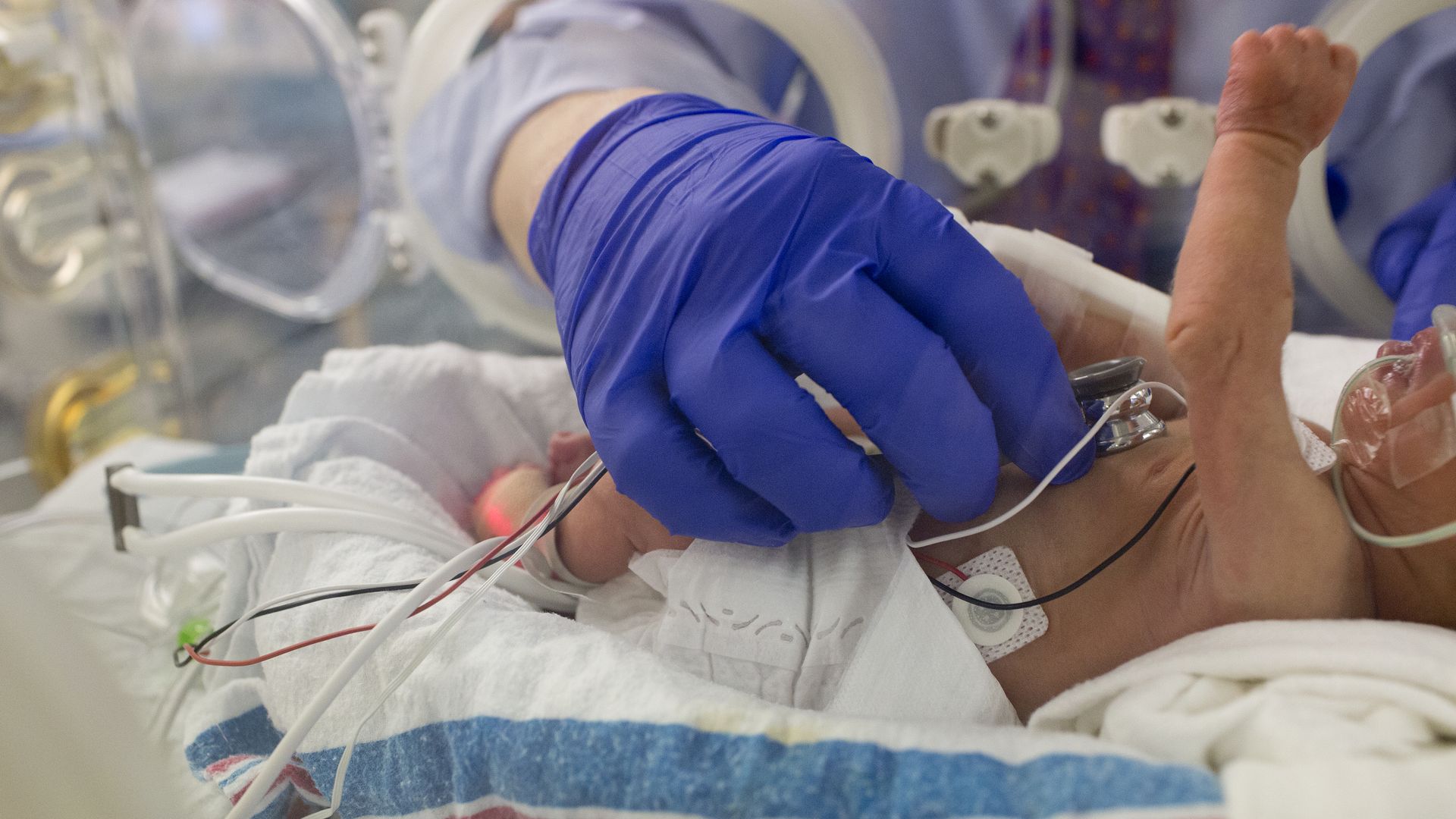Premature baby in a hospital NICU unit