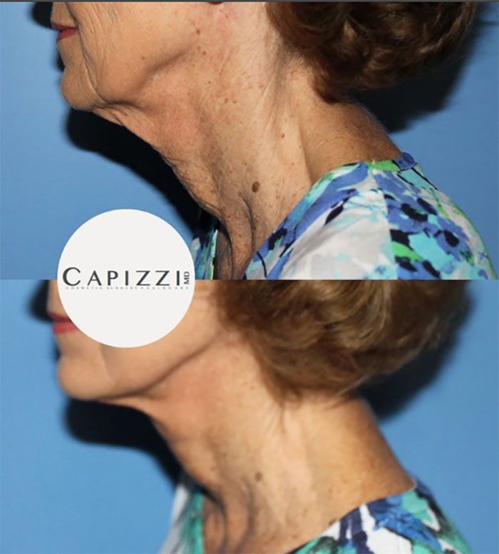 neck lift plastic surgery