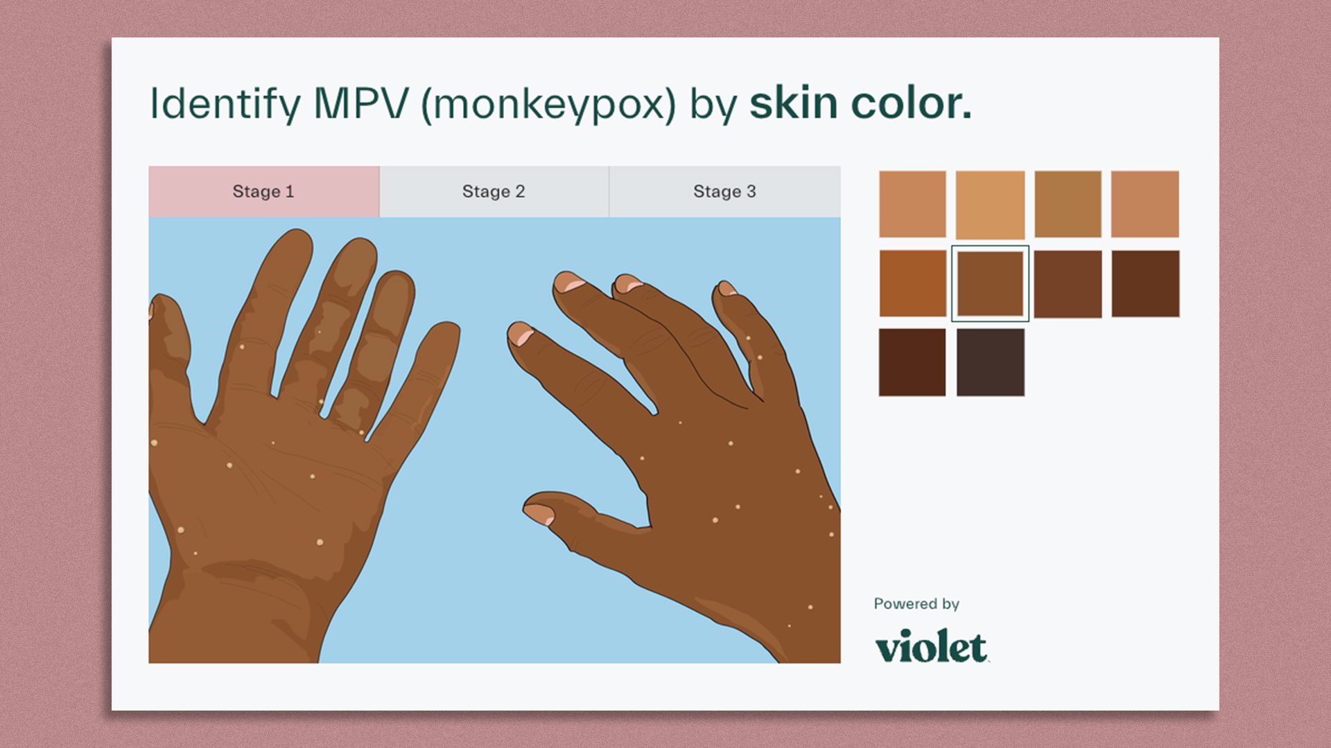 Startups' Tool Helps Doctors Identify Monkeypox On Dark Skin