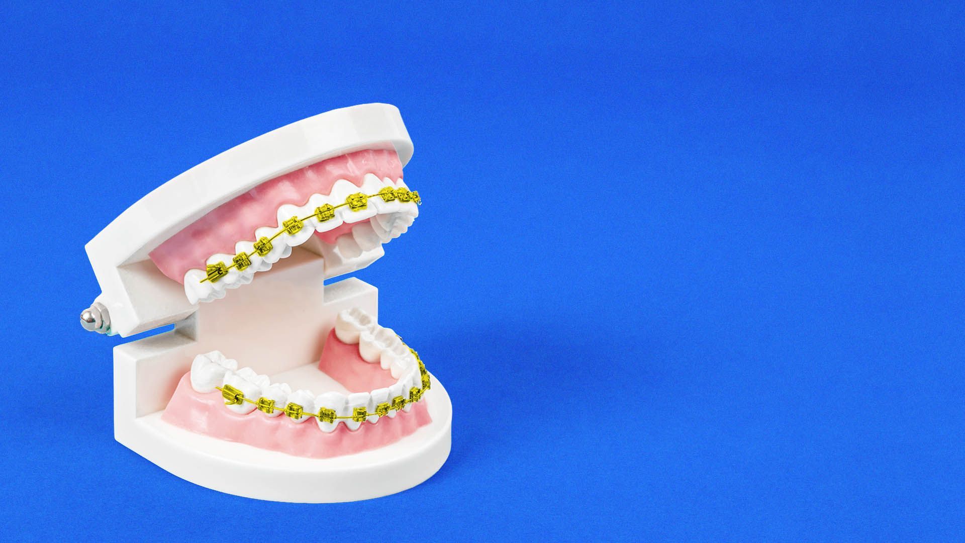 Illustration of a model of a mouth with golden braces.