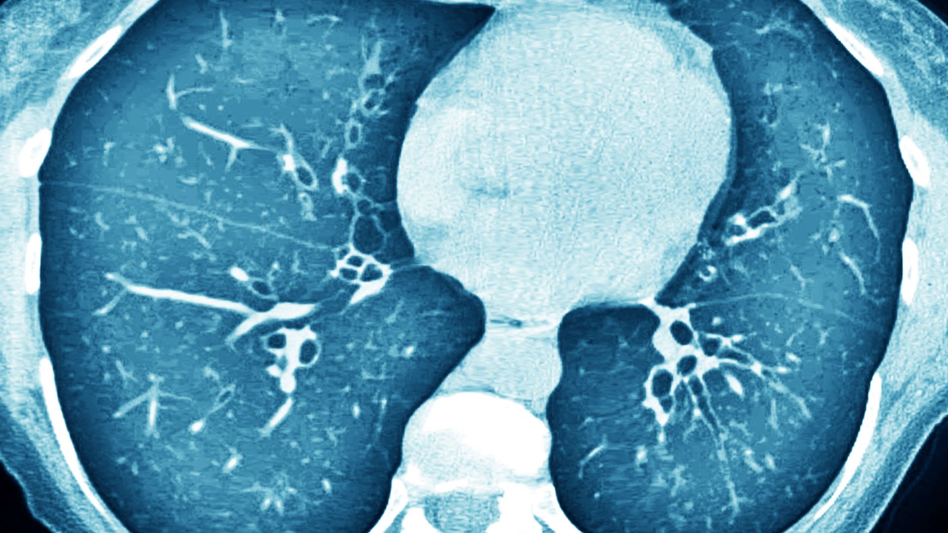 A scan showing cystic fibrosis
