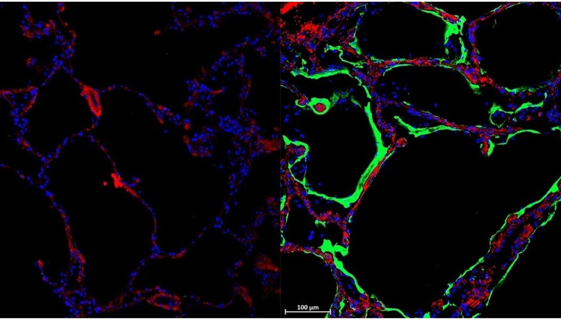 Left: A healthy control lung. Right: Immunofluorescent staining showing the newly discovered SARS-CoV-2 spike-receptor LRRC15 in green in post-mortem lung tissue of a person who died of COVID-19.