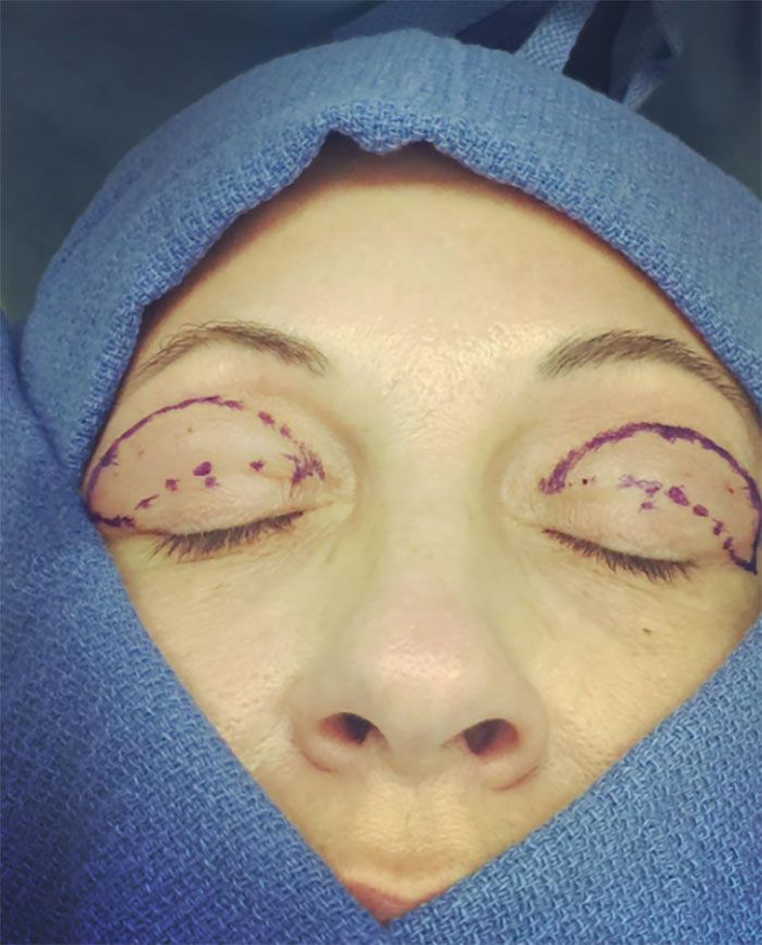 eye-lift-plastic-surgery