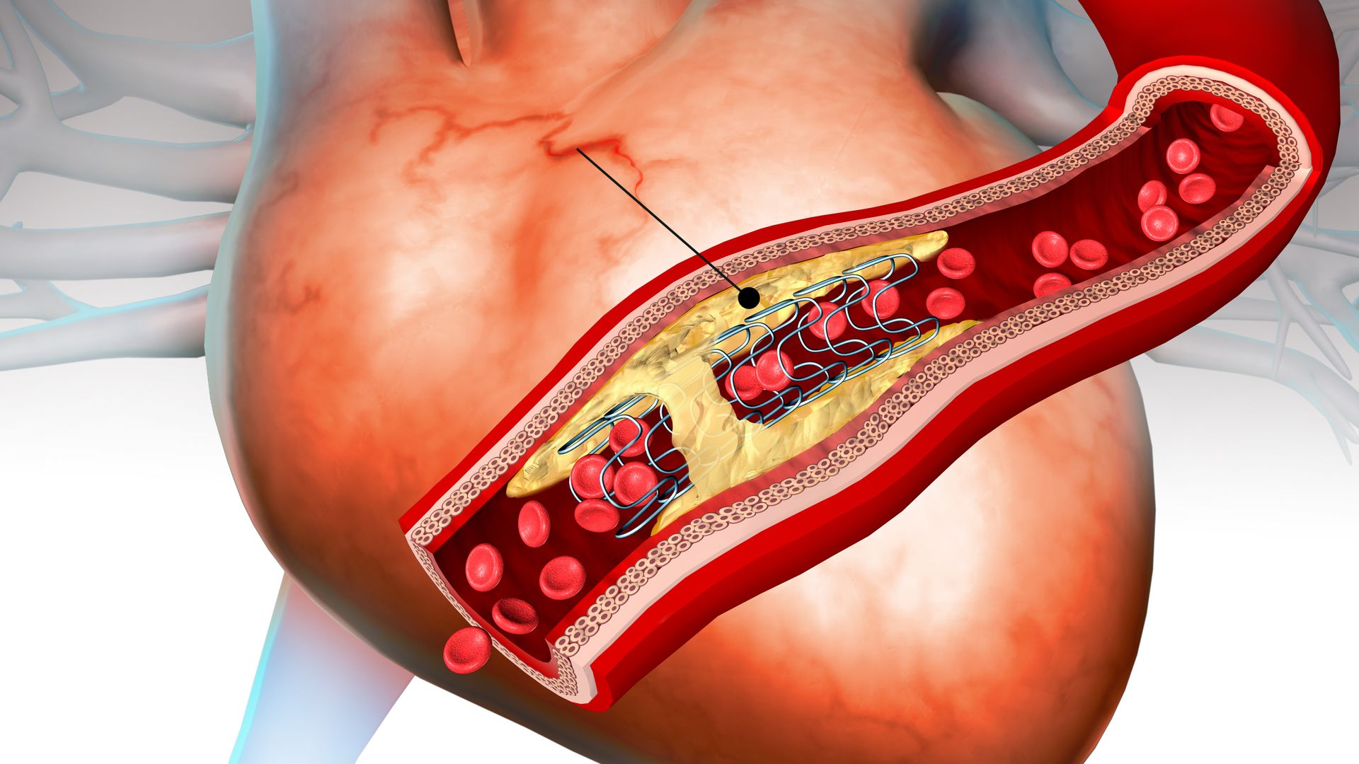 An illustration of a heart vessel with a stent inside.