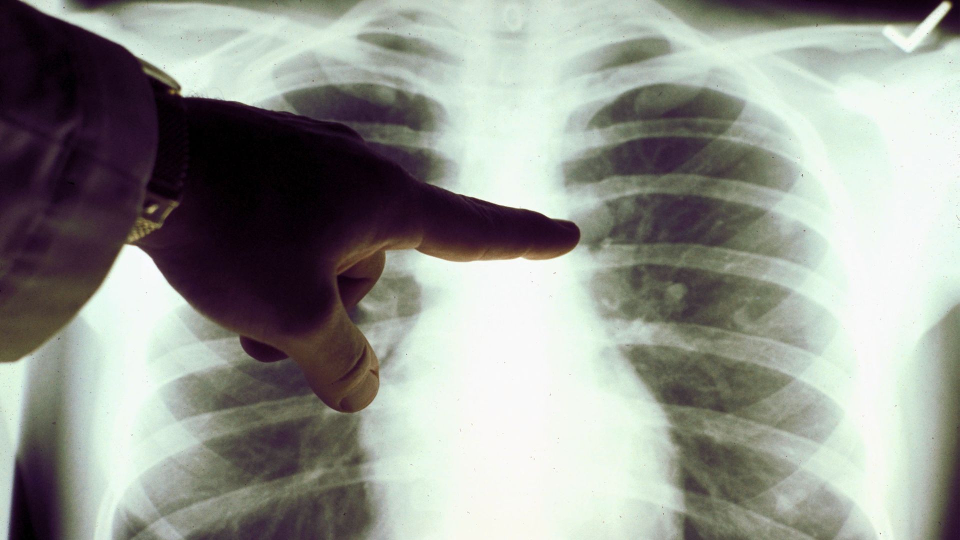 A hand pointing at an x-ray of human lungs.