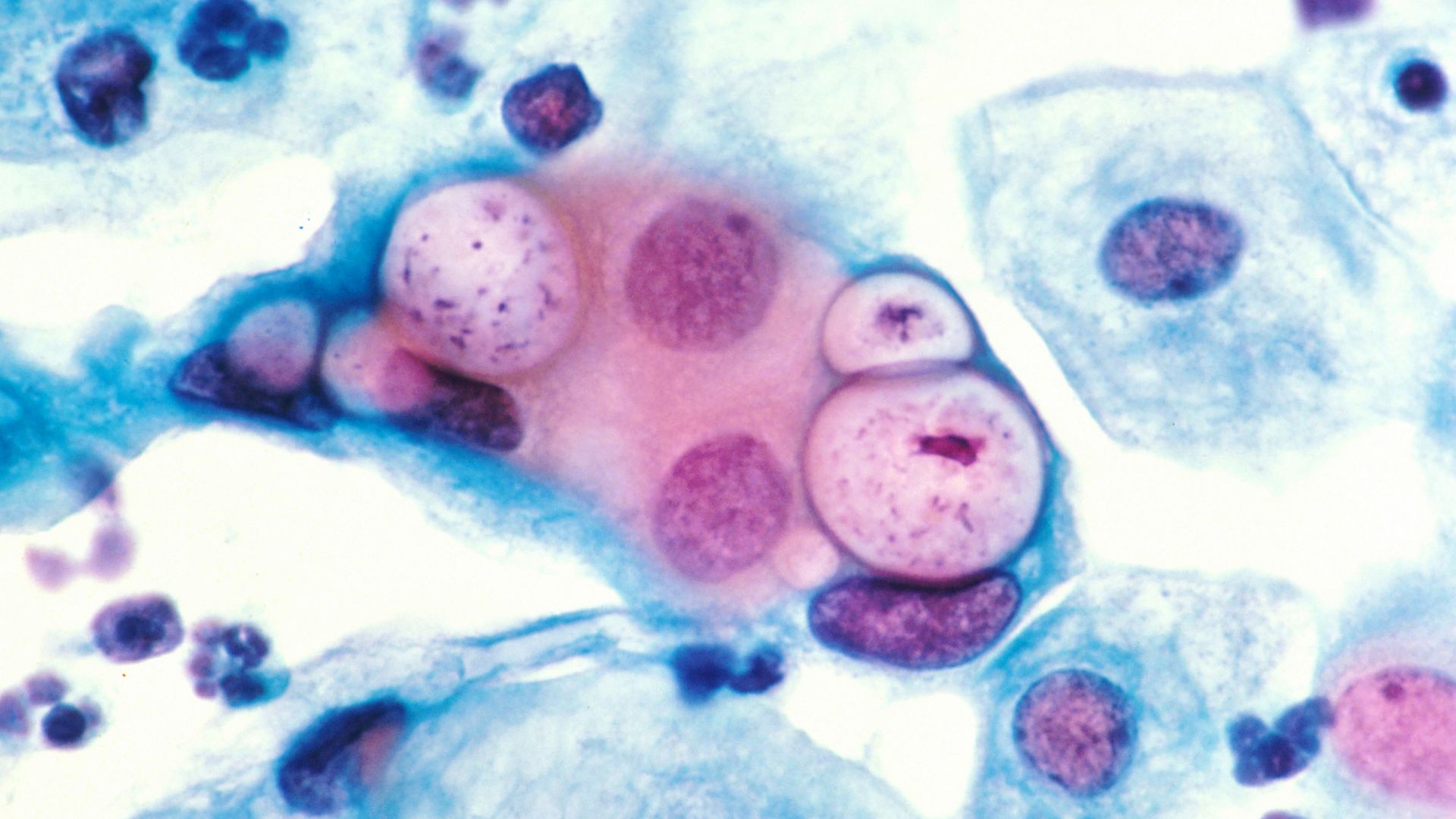 Human pap smear showing chlamydia in the vacuoles at 500x and stained with H&E