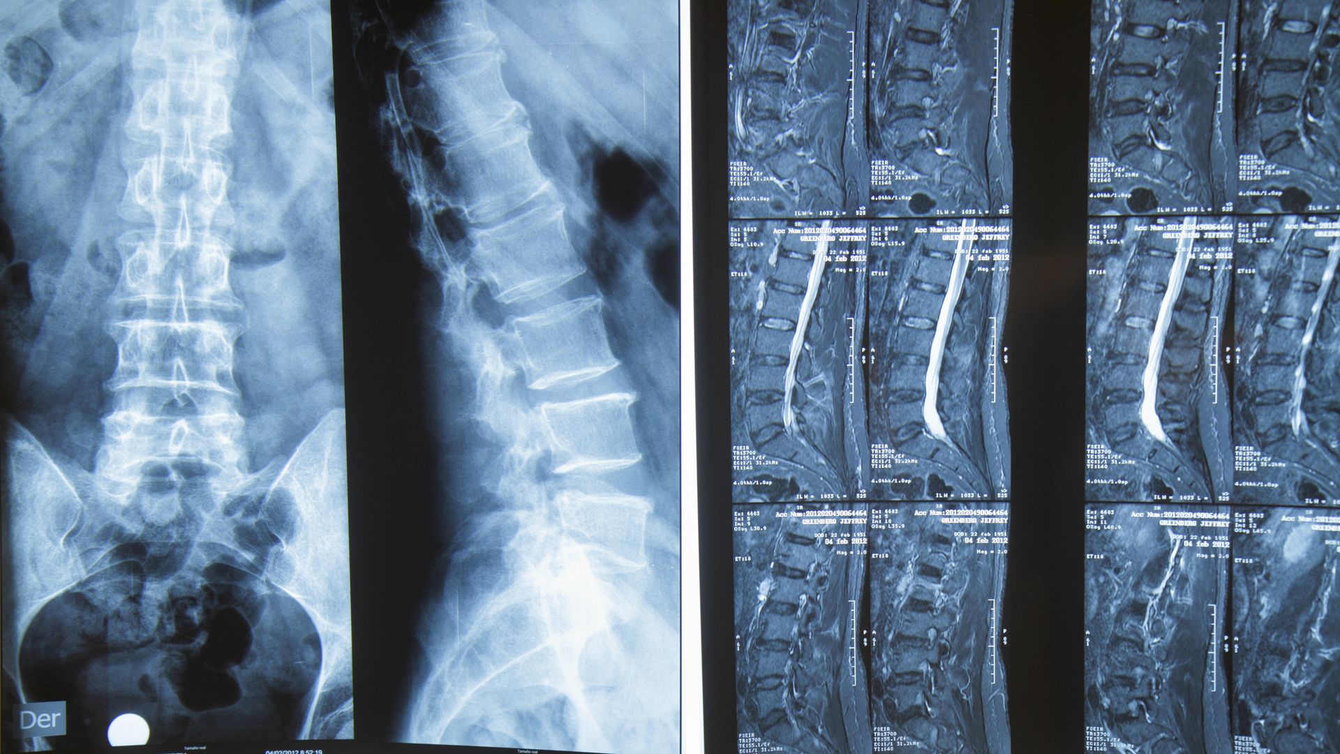Spine x-rays at a hospital.