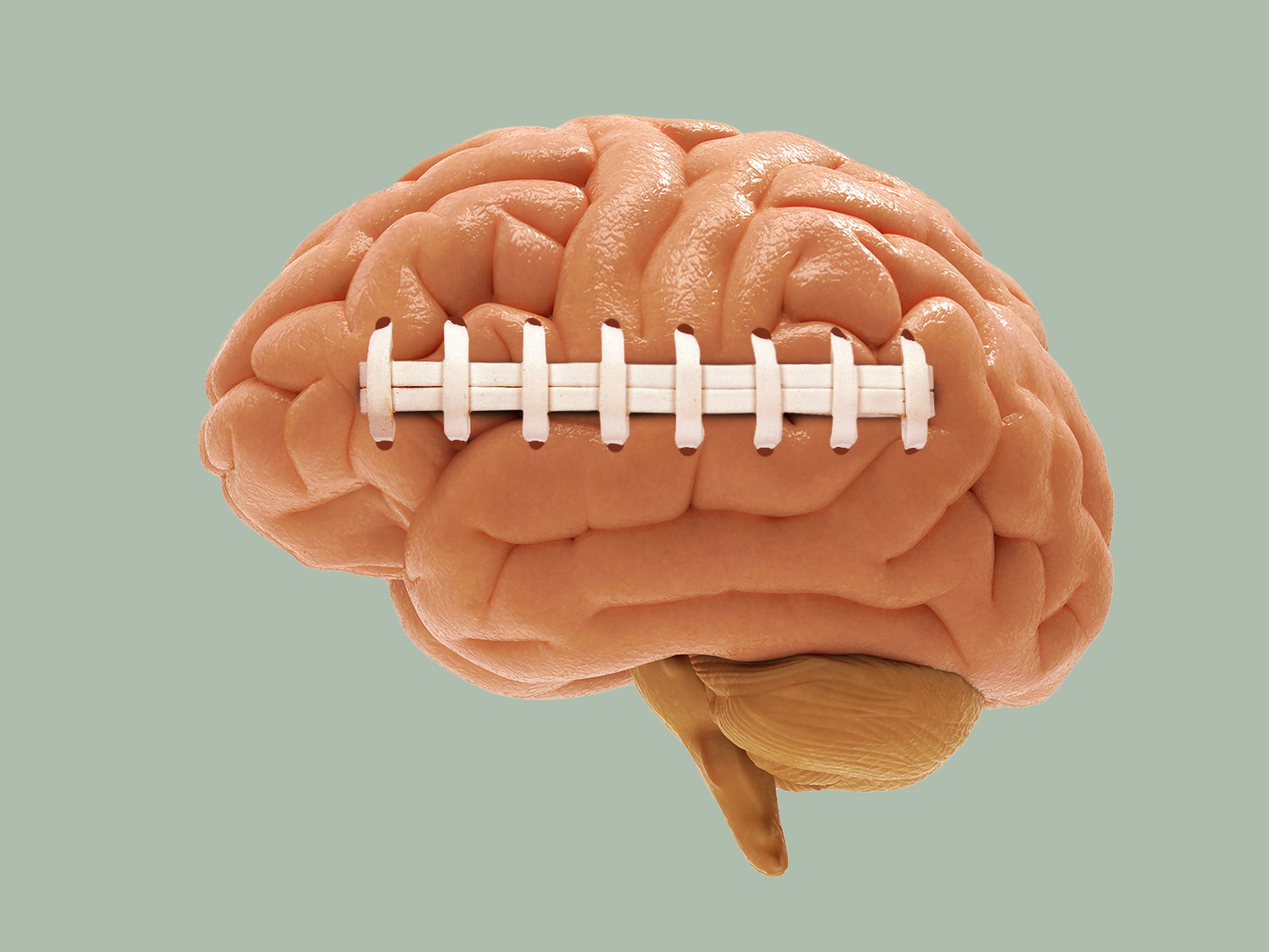 Study of former football players' brains finds CTE in nearly all of them