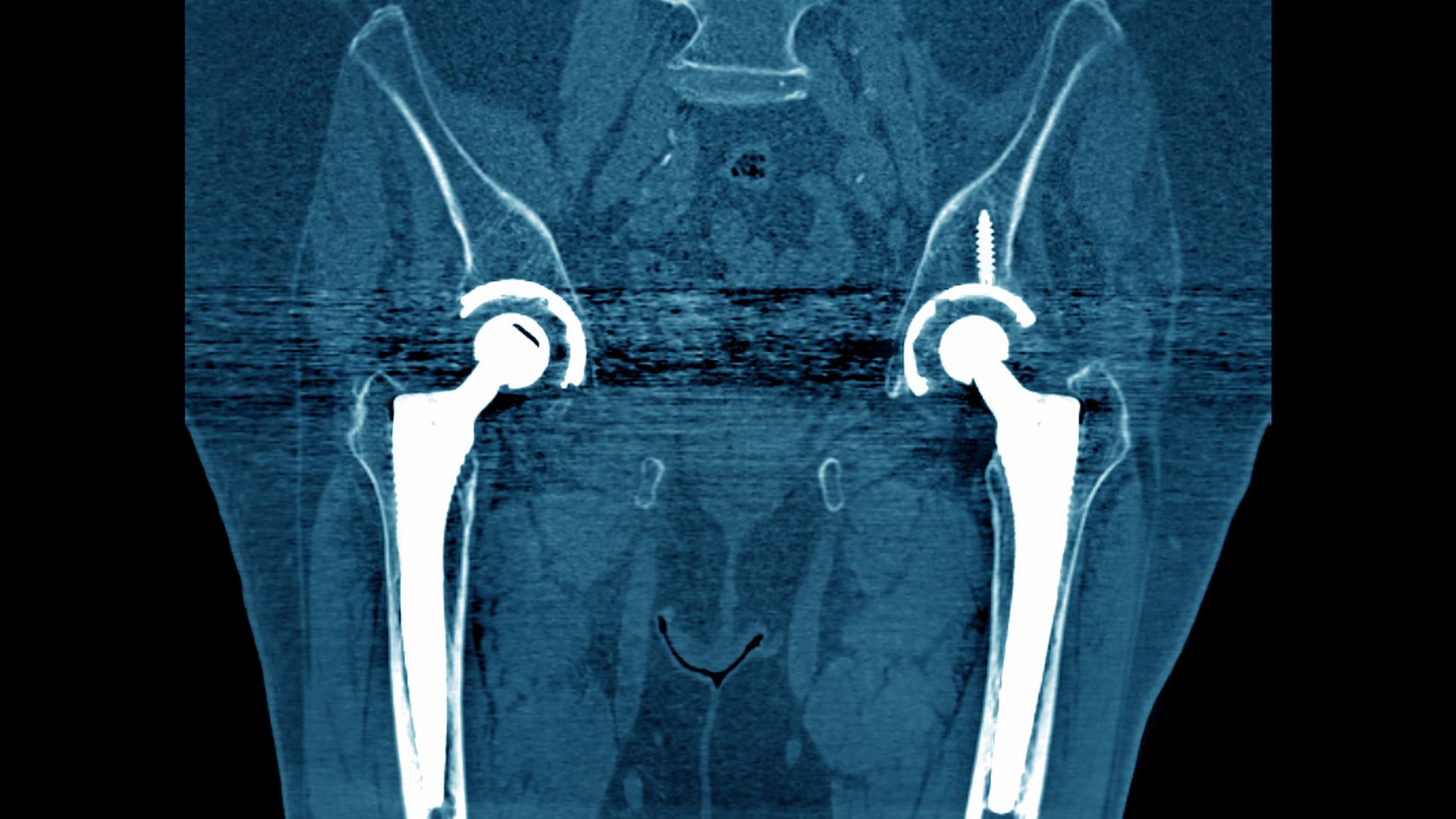 A CT image of hip implants.