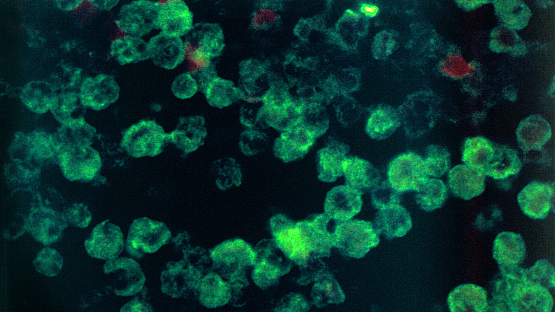 A case of amebic meningoencephalitis due to Naegleria fowleri parasites.