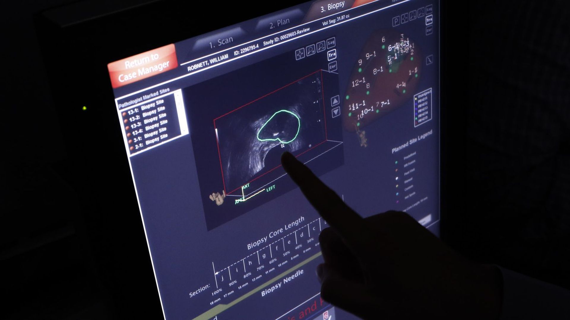 An image of a prostate which was biopsied for prostate cancer.