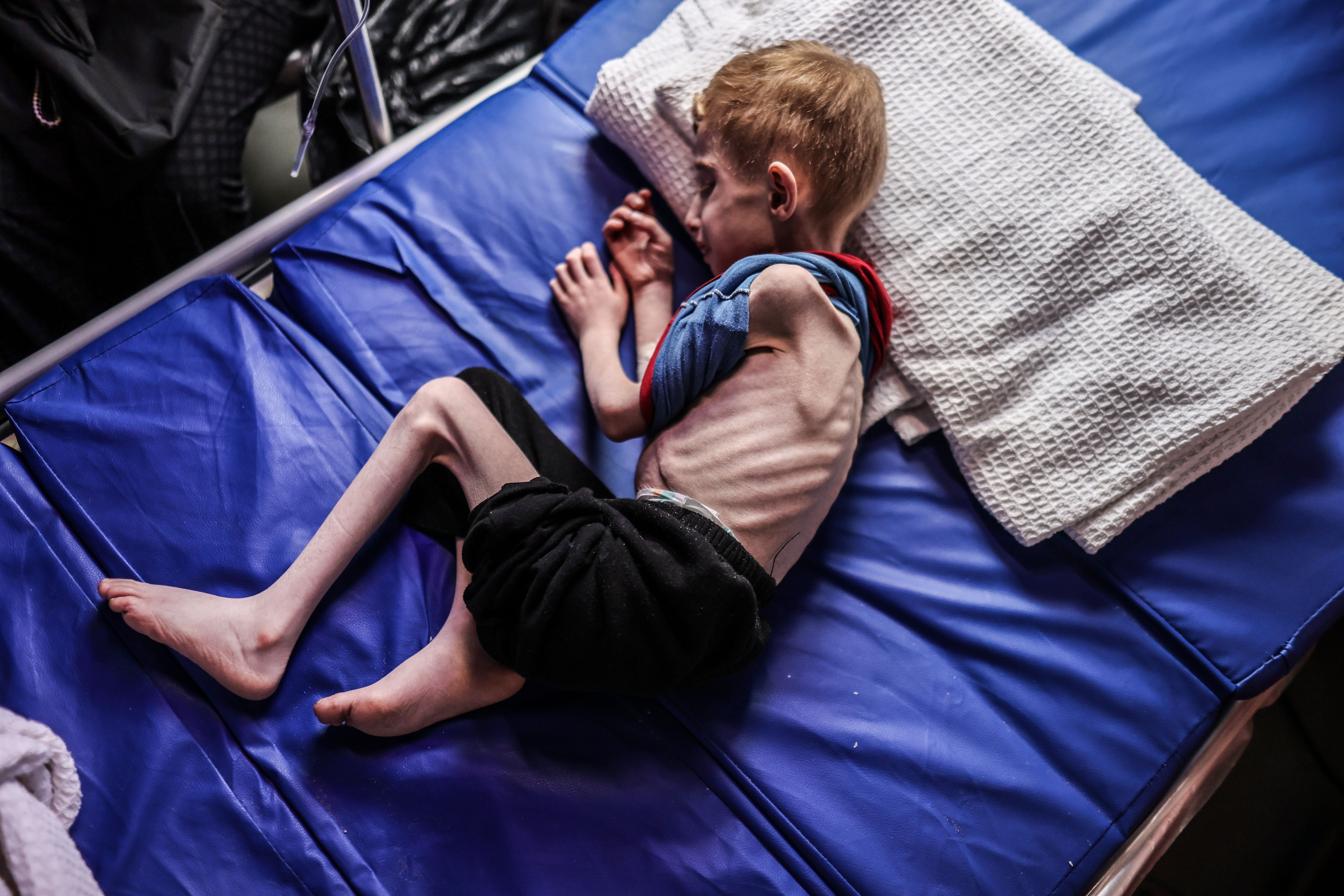An image of an extremely thin and bony boy laying on a bed exhuasted from malnutrition. 