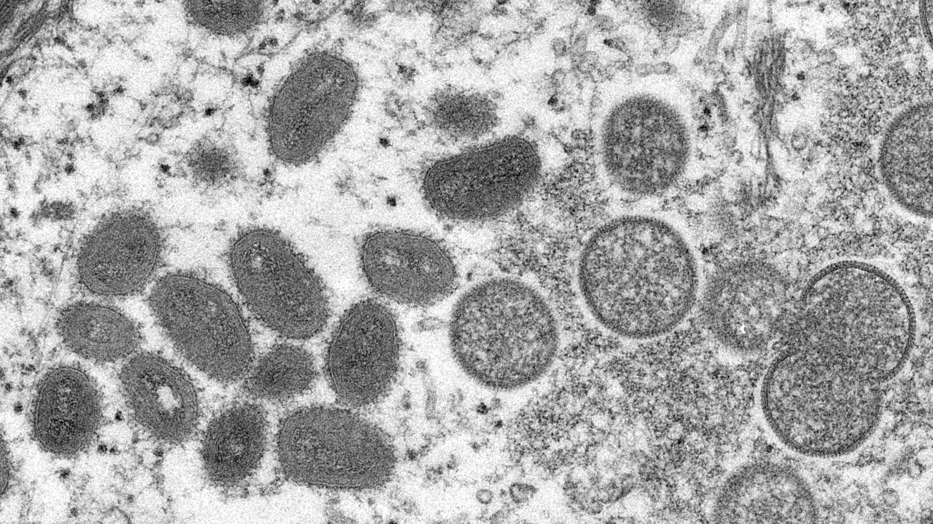 Electron microscope image of various virus particles of the monkeypox virus taken from human skin