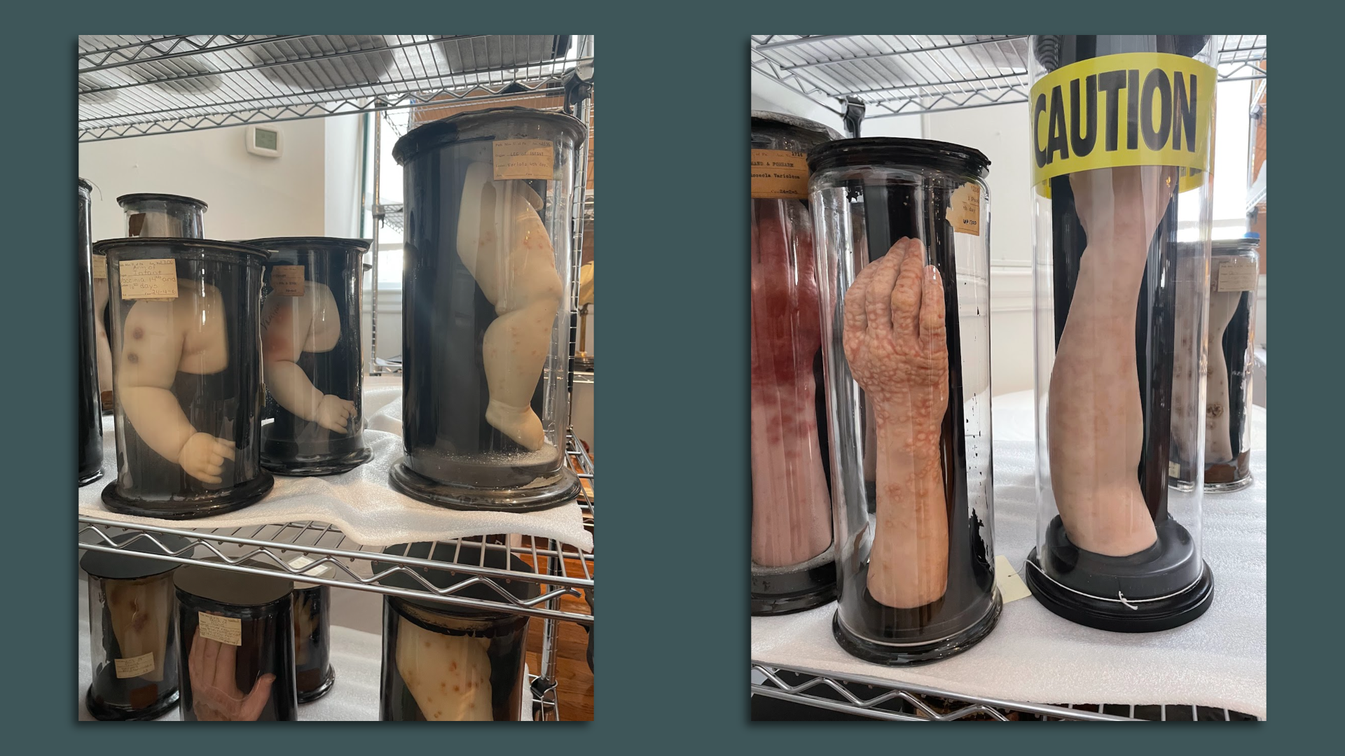 A photo of wax molds of human limbs made by an artist for doctors to study smallpox infection and vaccination.