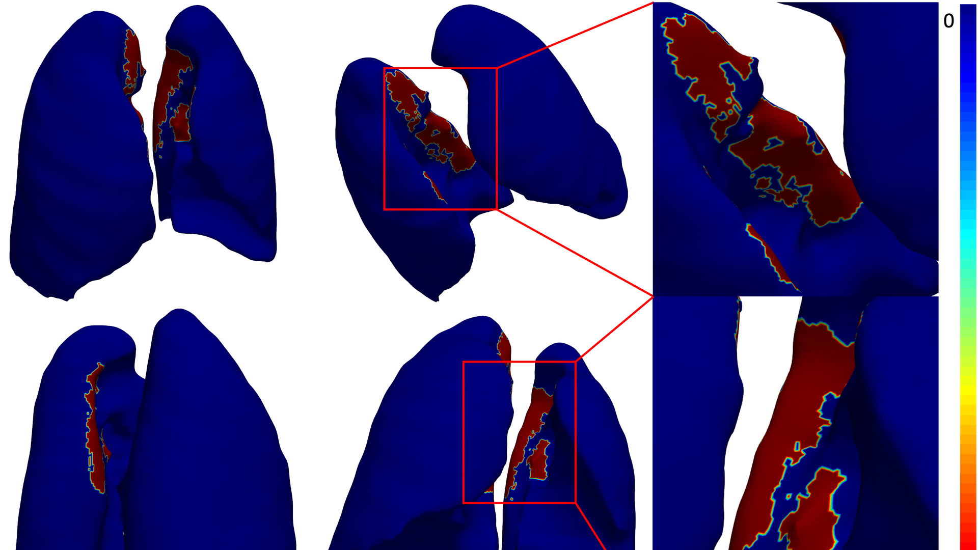 3D model of lungs with COVID-19 damage. Blue areas show mild COVID-19. The red area is severe COVID-19. Photo: Emory University