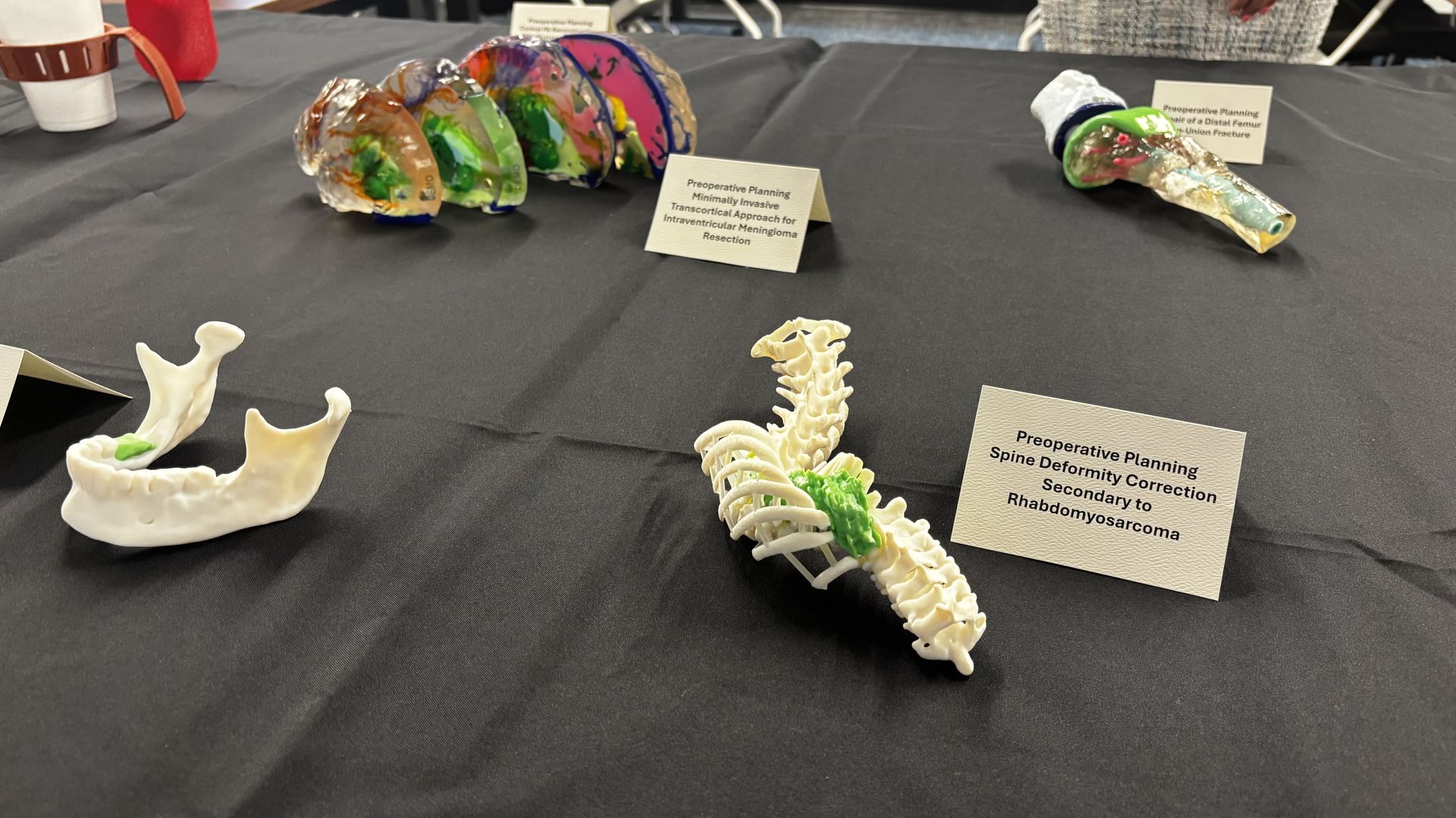 An exhibit table with anatomical models: a colorful translucent spine segment, a white jawbone, a compact spine model, and labeled cards about preoperative planning; coffee cup on the left.