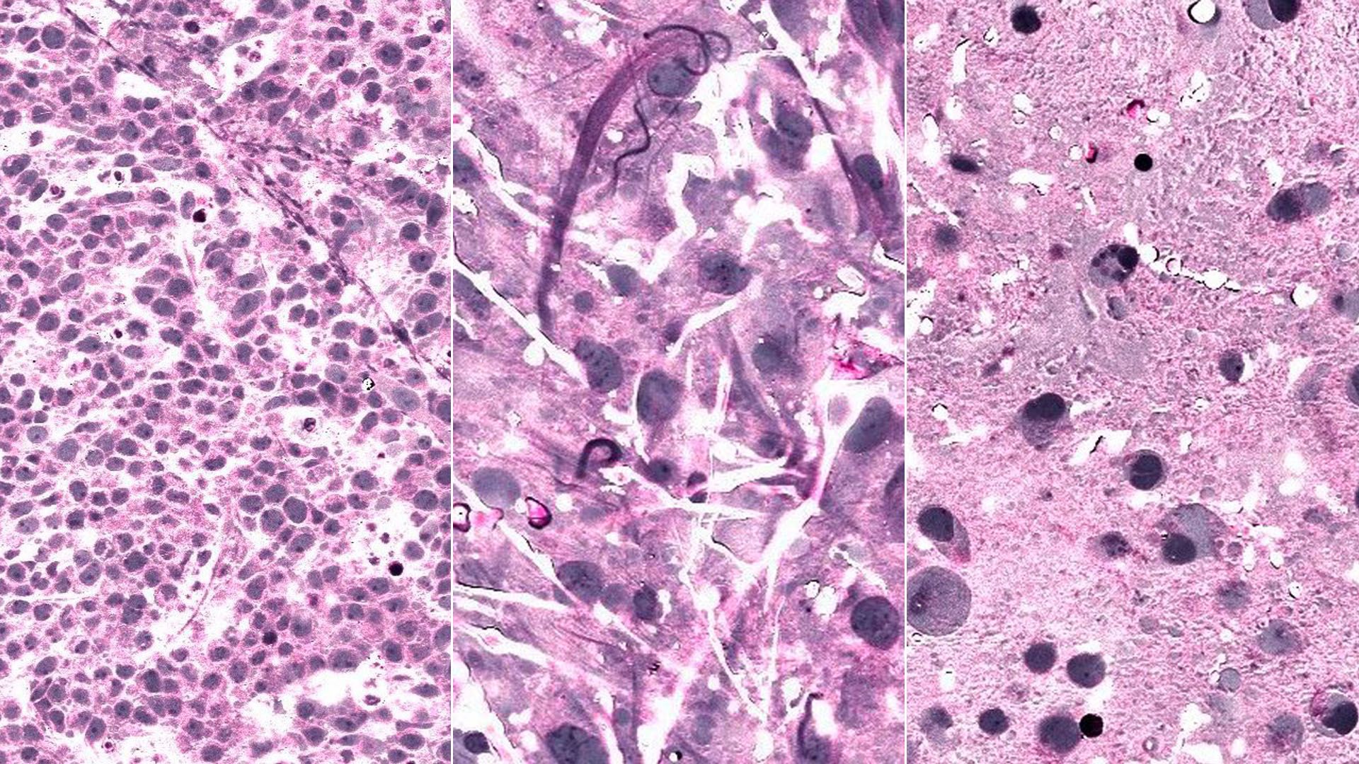 Photo collage of three SRH images of brain tumor biopsies