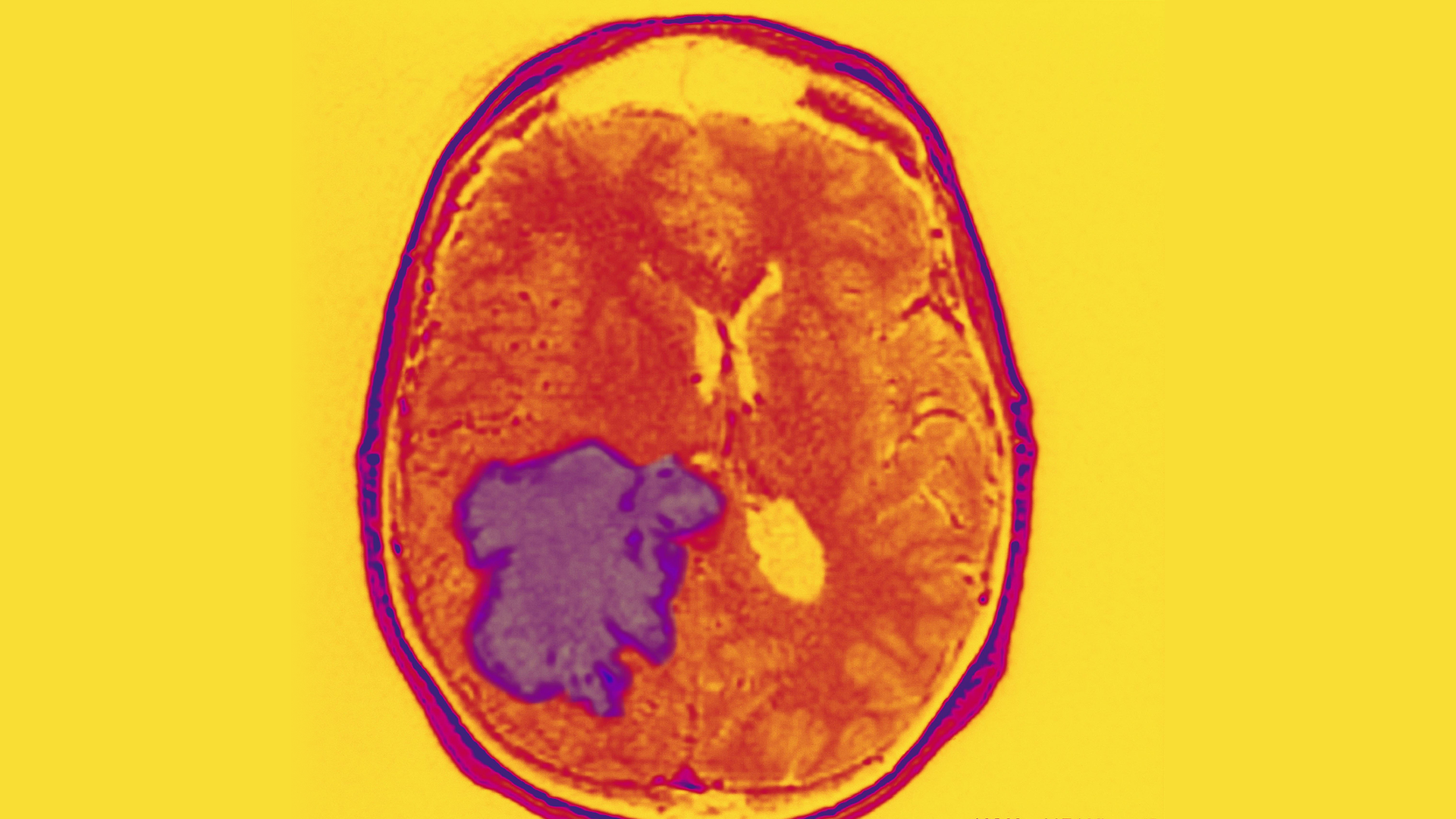 Photo of MRI of skull of patient with a glioblastoma tumor