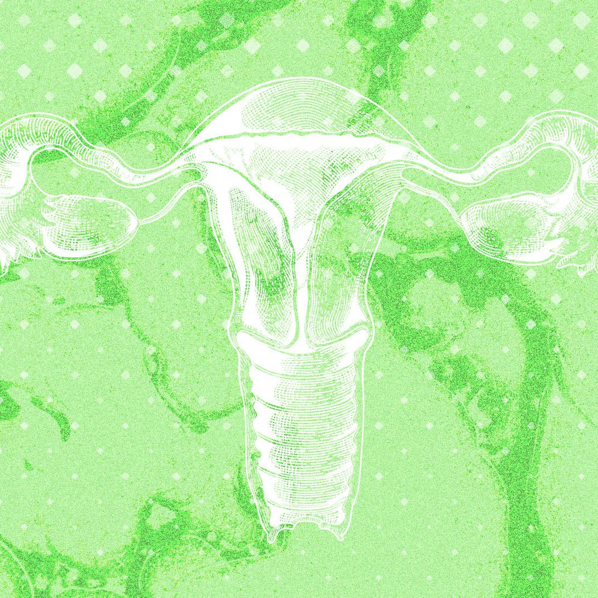 Illustration of a medical diagram of a uterus with pills falling all around it. 