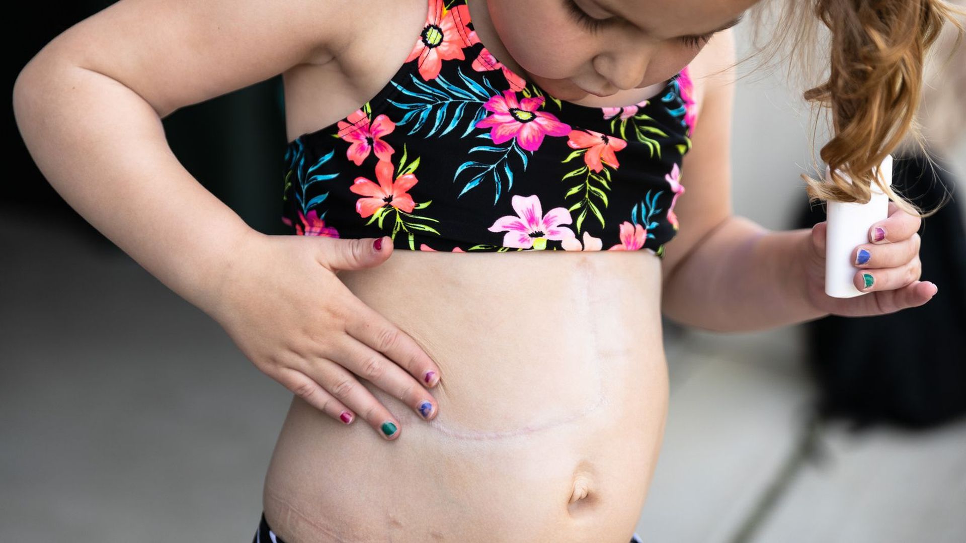 A girl rubs sunscreen on her liver transplant scar.