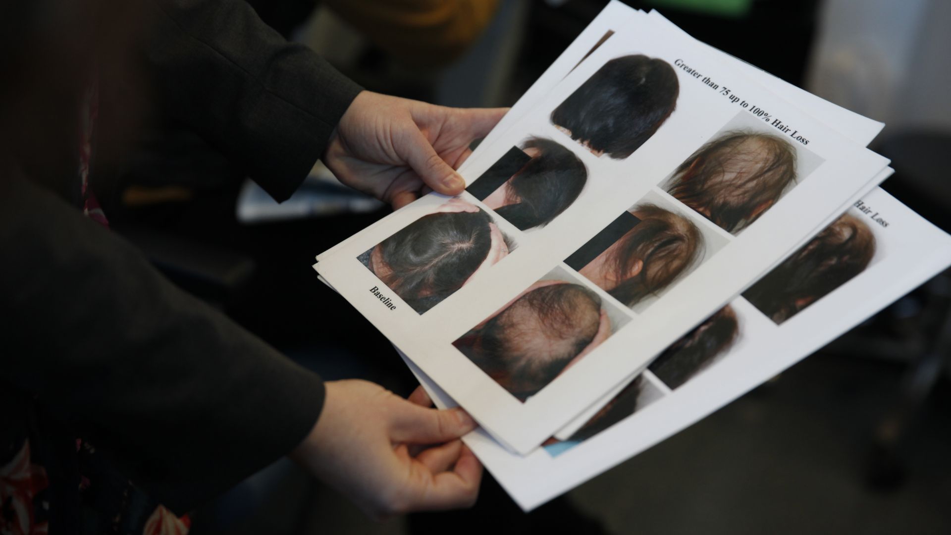 Elizabeth Ver Hoeve, UCSF clinical research coordinator, holds standardized photos of different ranges of hair loss used to help patients fill out an alopecia self-assessment.