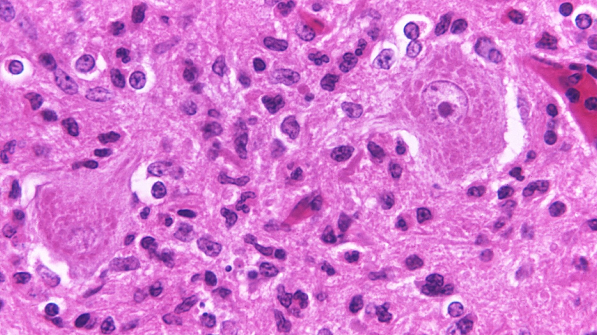 A photomicrograph of brain tissue from a rabies encephalitis patient.