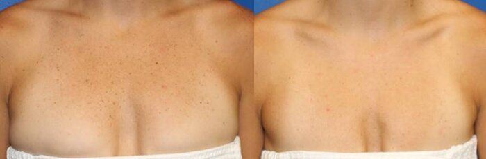 criswell before and after bbl