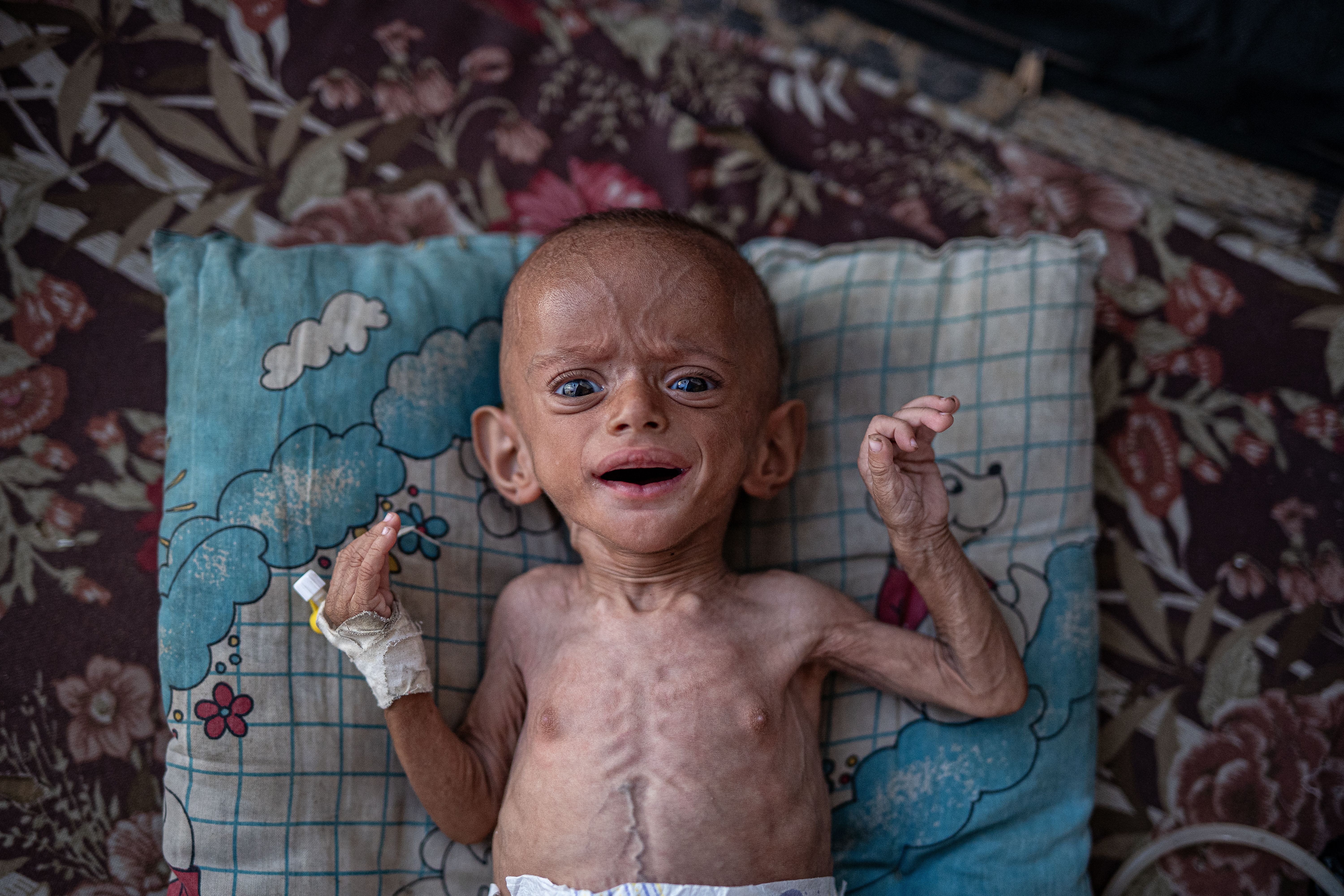 A child suffering from malnutrition. 