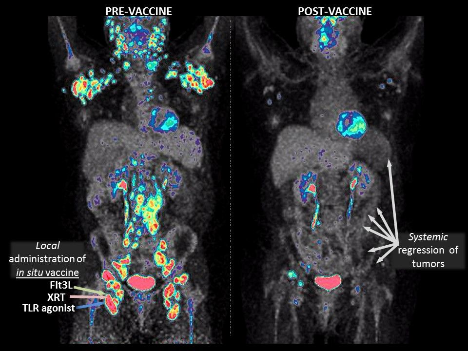Photo from science study of tumors before and after vaccine treatment