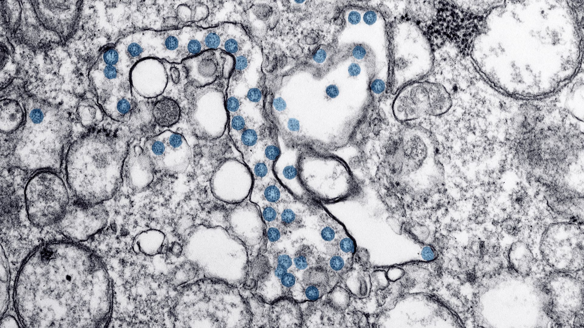 This image is a microscopic view of COVID-19