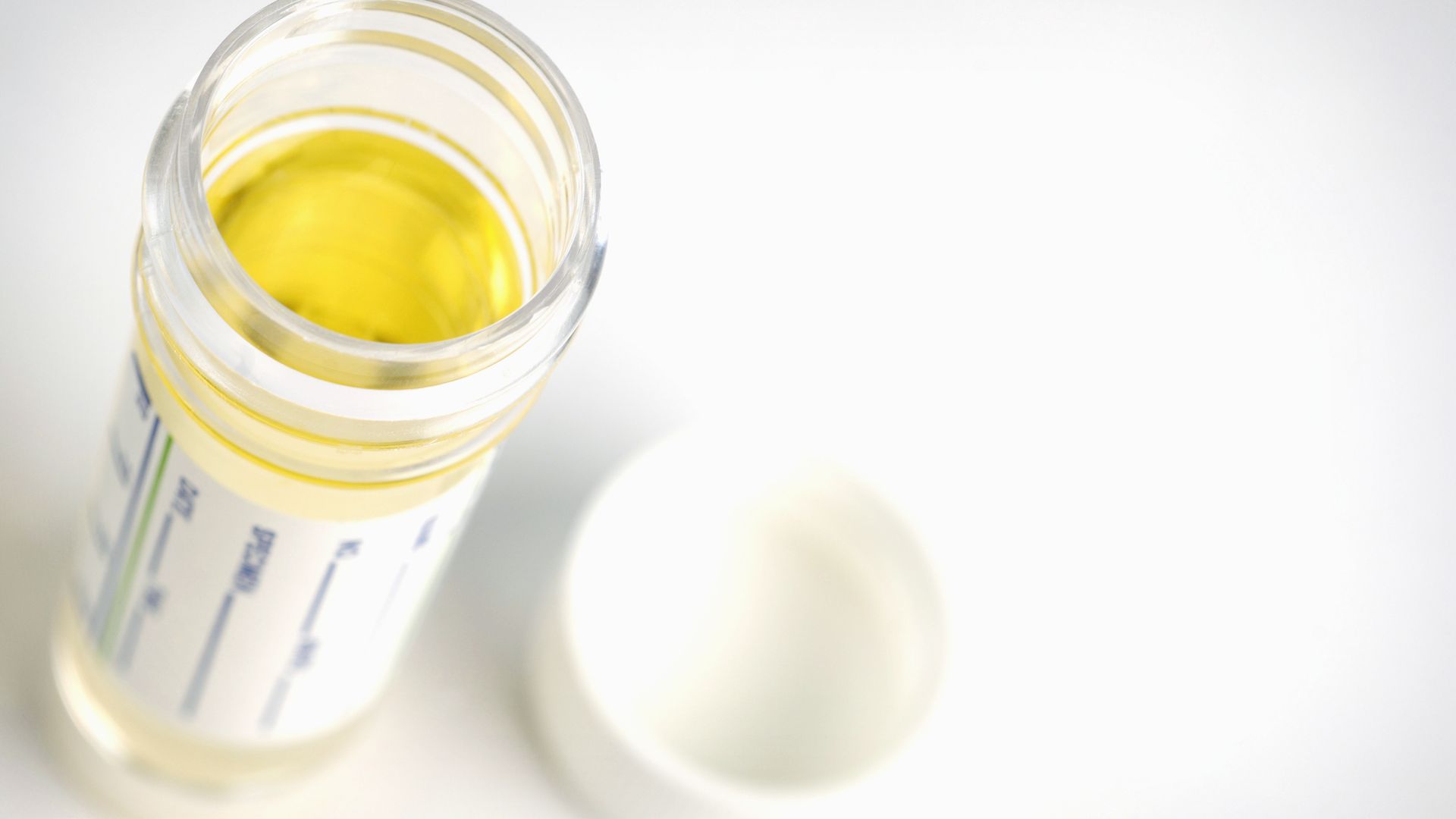 A urine sample at a lab