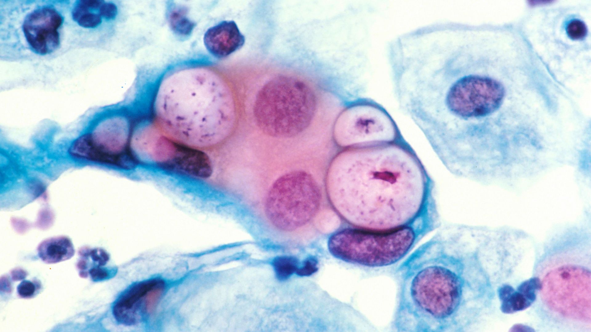 Human pap smear showing chlamydia in the vacuoles at 500x and stained with H&E. (Photo by: Media for Medical/UIG via Getty Images)