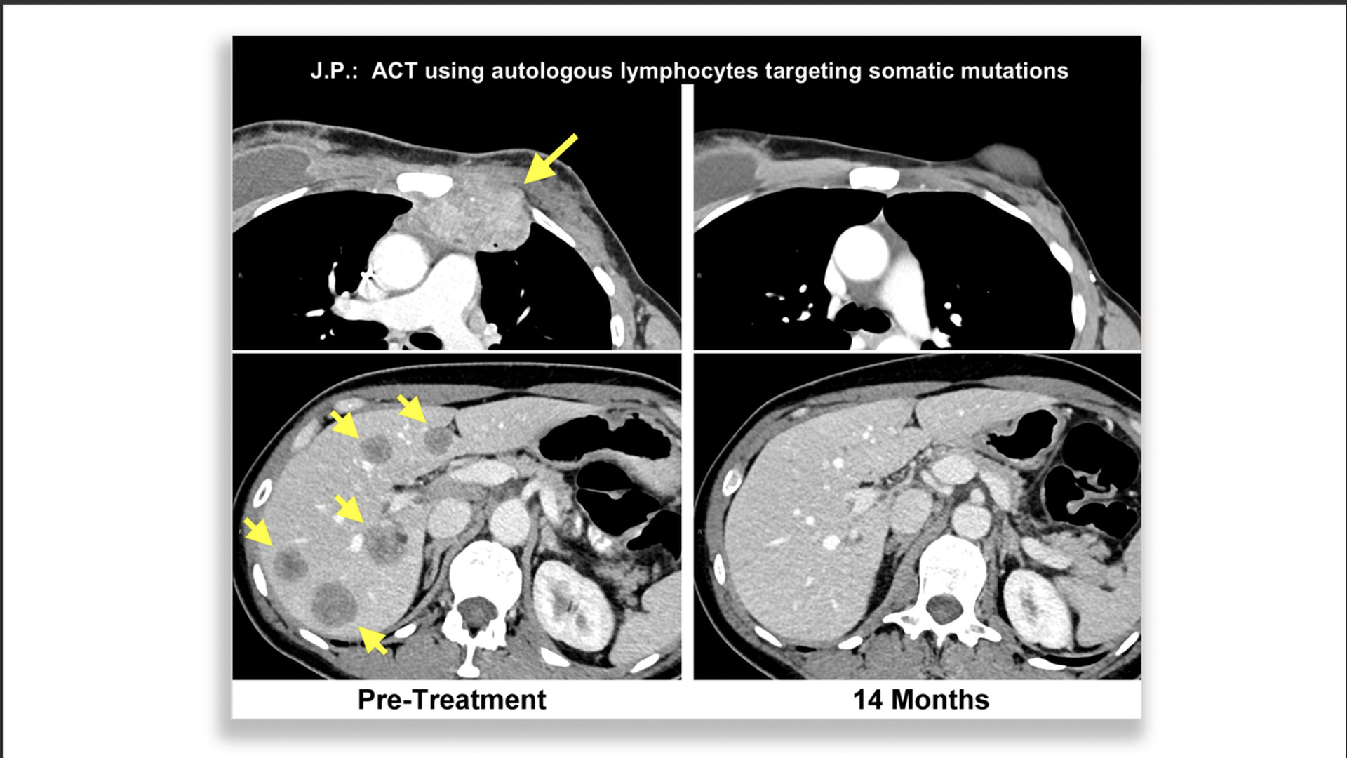 Scan showing breast cancer patient before and after successful immunotherapy treatment