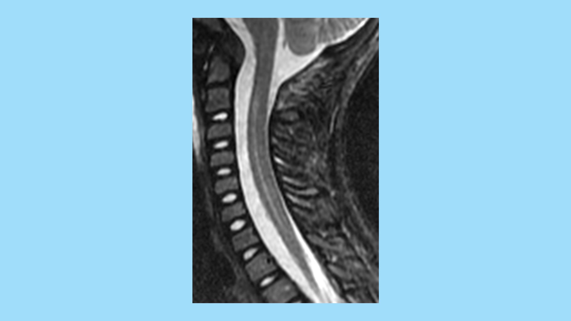 MRI of pediatric patient with AFM shown at a 2014 grand rounds presentation at Children's National.