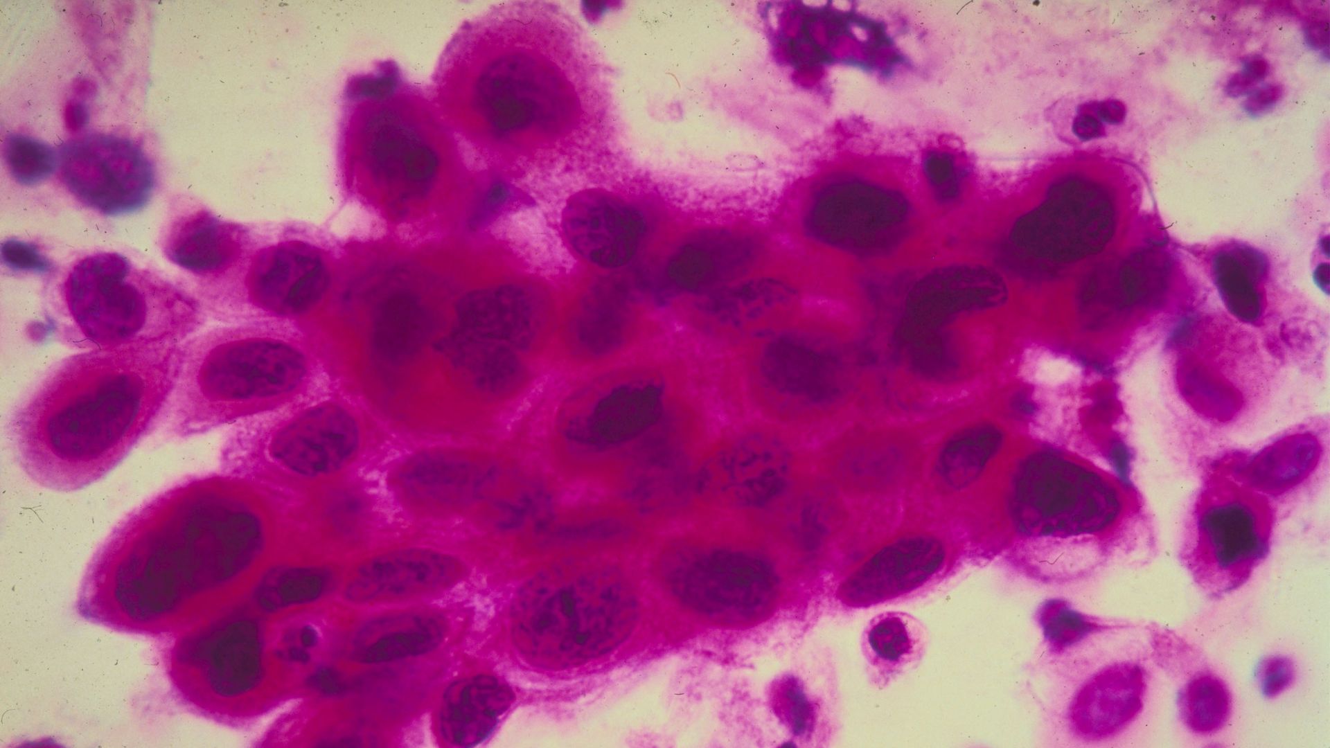 Close up of cancer cells in the cervix.