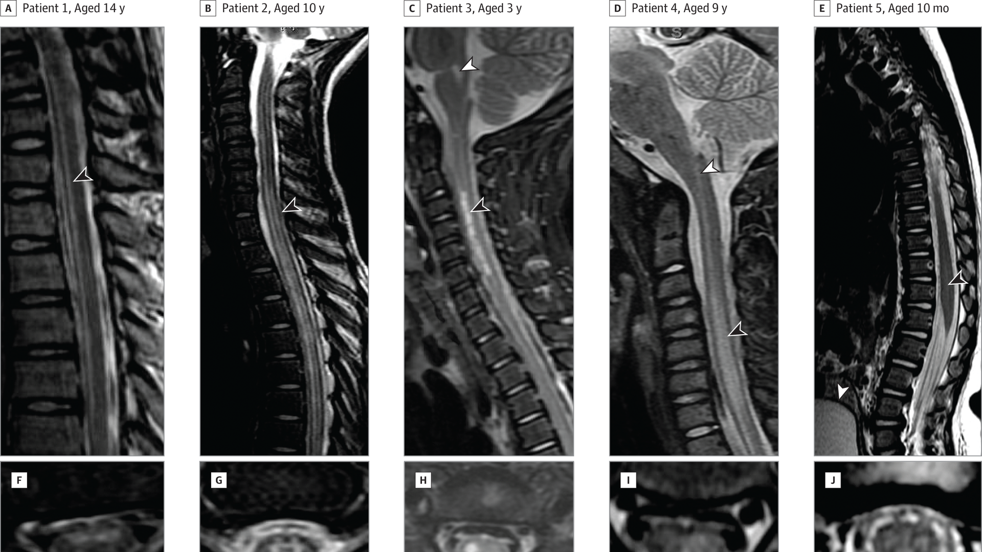 Photo of xray images of several young children's spines with AFM