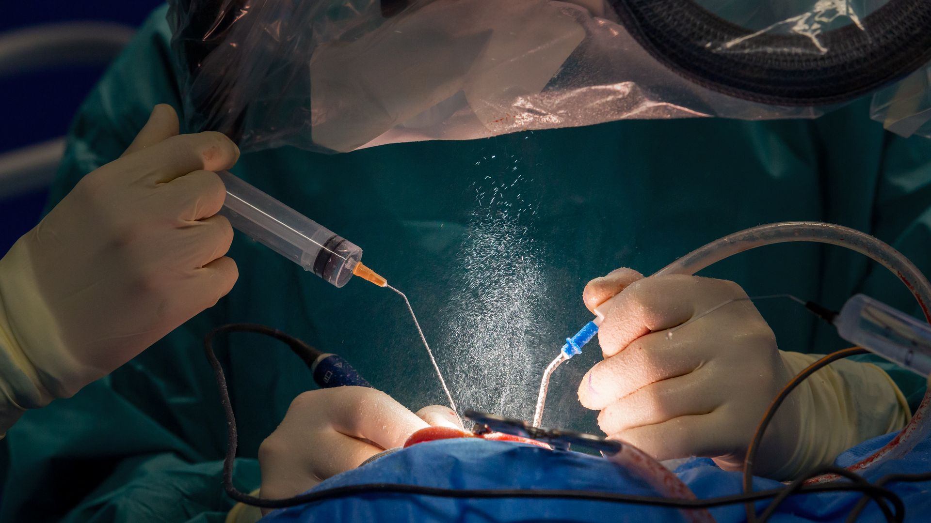 Doctors insert a cochlear implant in a patient. 