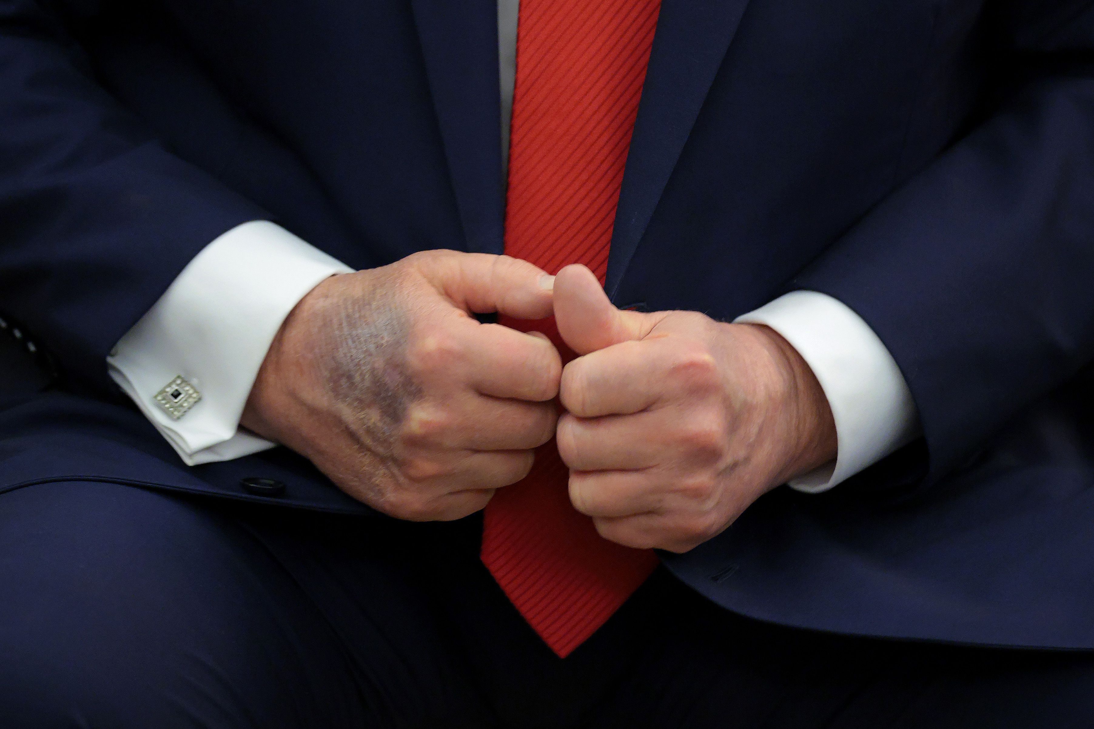President Donald Trump seated at a table in the Oval Office showing a visible bruise on the back of his right hand as he meets South Korean President Lee Jae-myung.