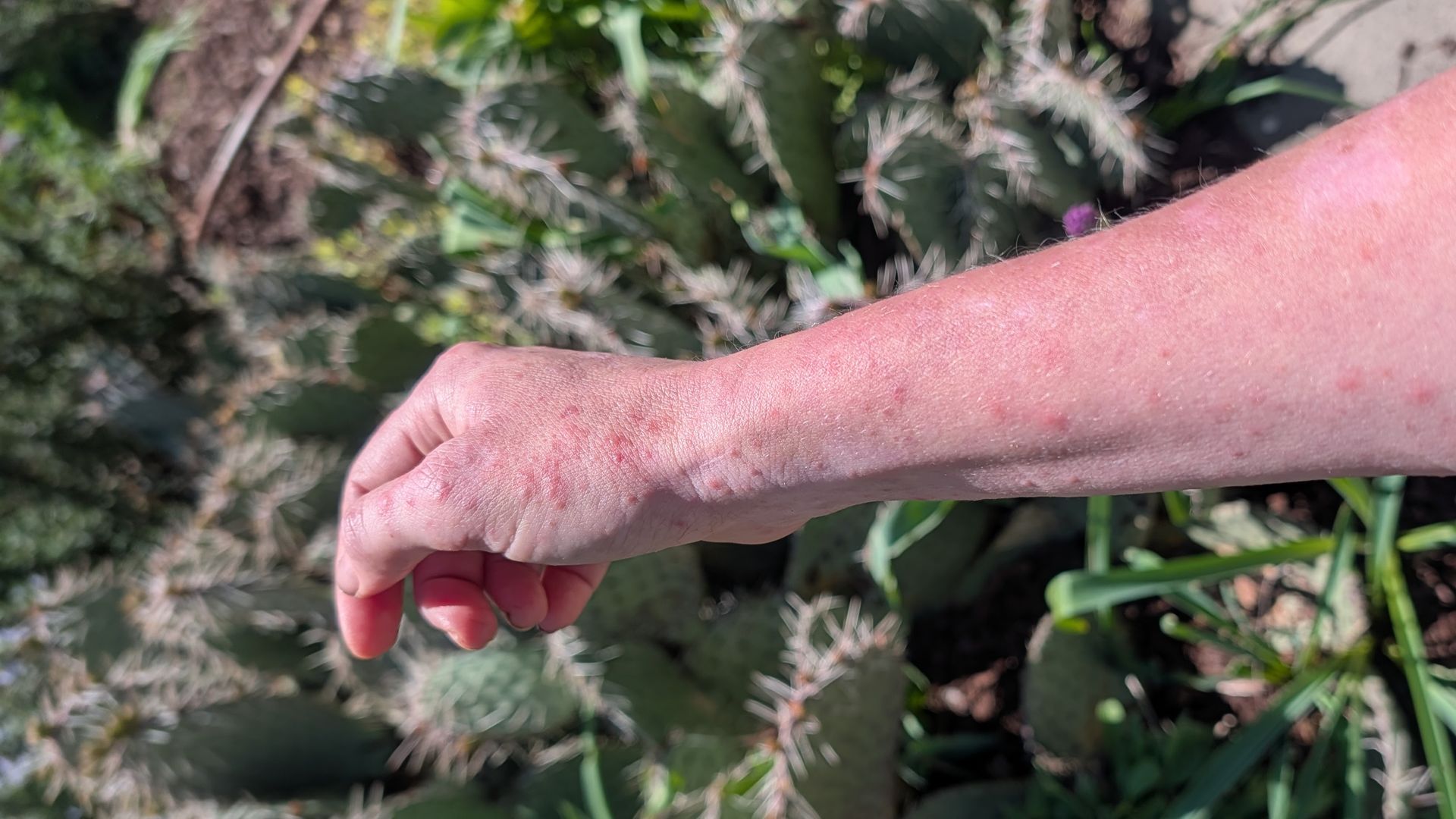 A person's hand covered in pricks from a cactus, which is in the background.